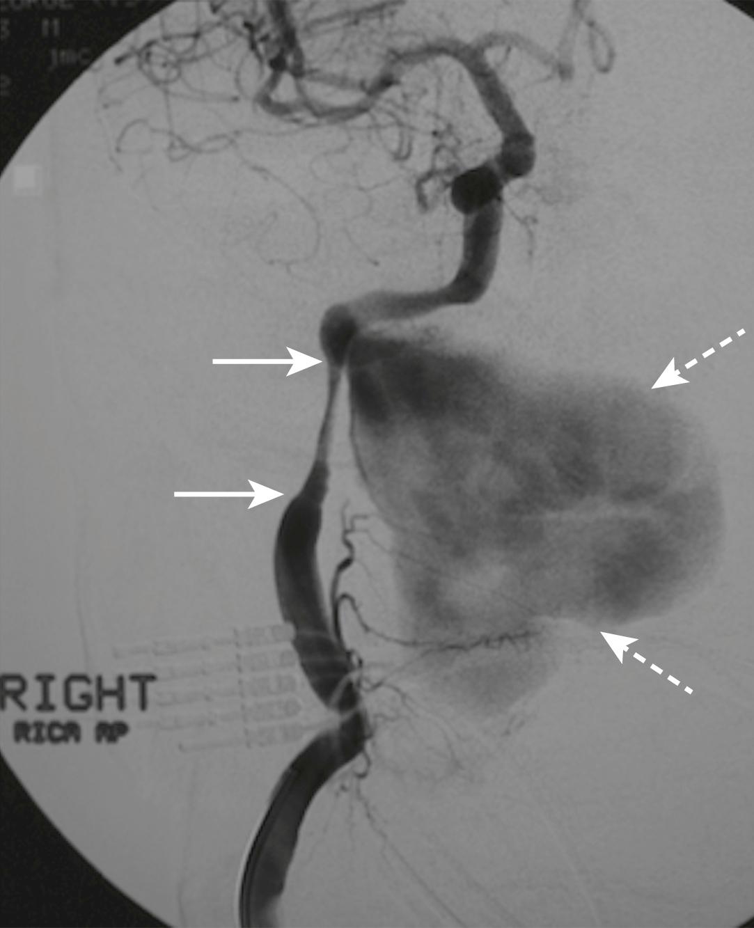 E-FIG. 3.8.2, Right internal carotid artery angiogram demonstrating a short segment dissection within the distal cervical portion (arrows ) with a large associated pseudoaneurysm (dotted arrows) .