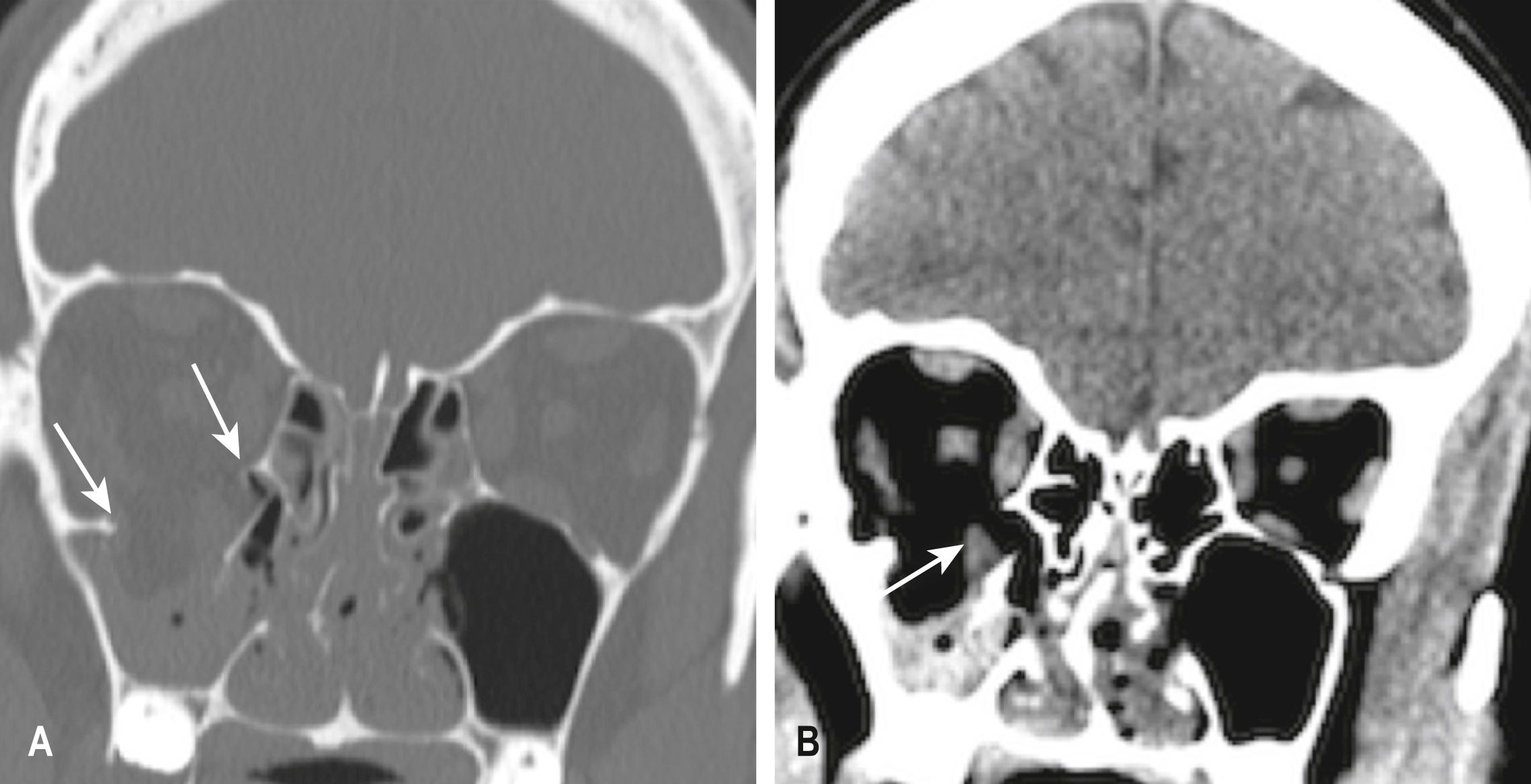 E-FIG. 3.8.4, (A) Fracture of the floor of the right orbit (arrows) . (B) image demonstrating herniation of the inferior rectus muscle into the bony defect (arrow) .