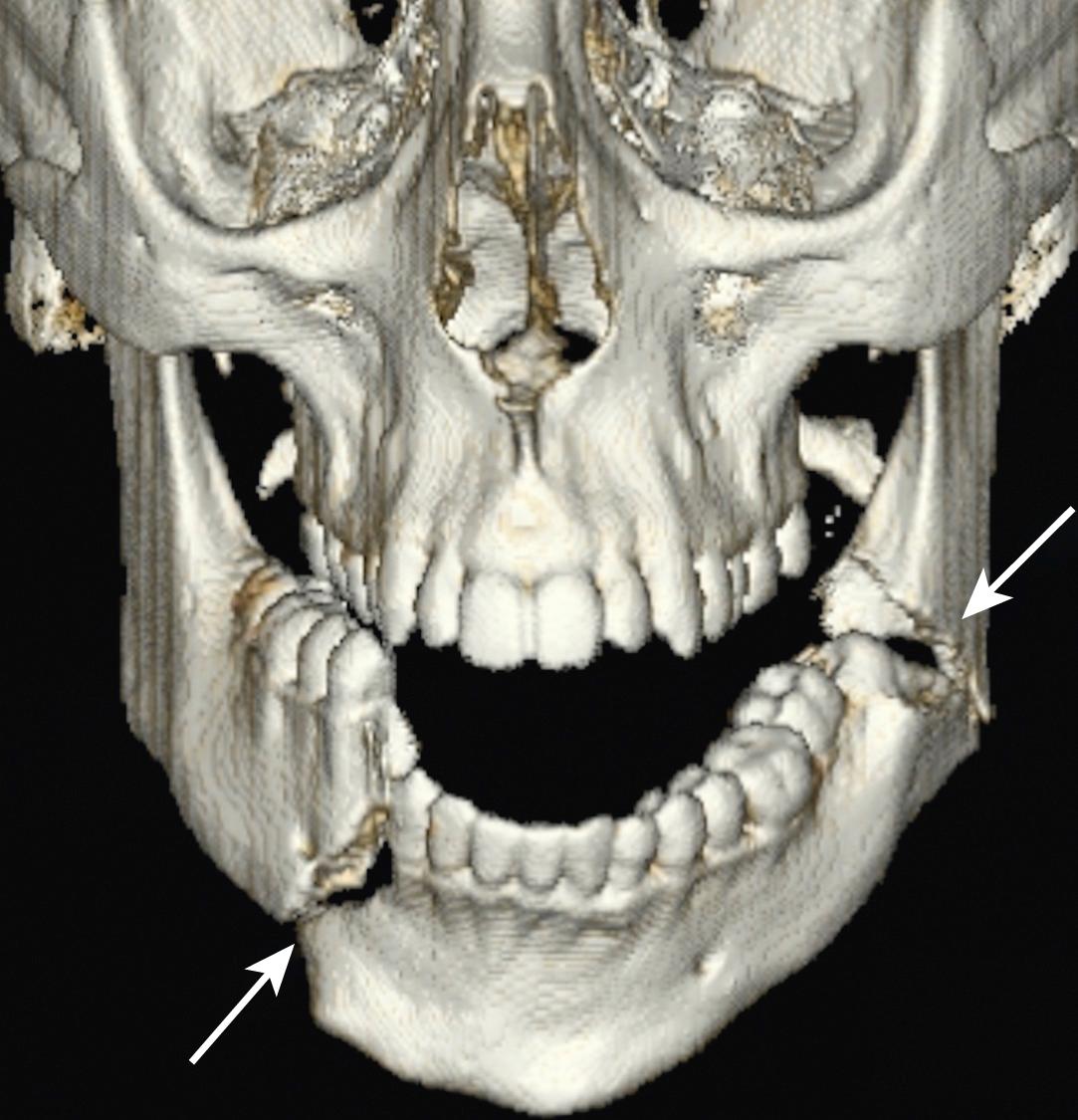 E-FIG. 3.8.5, Bilateral Mandibular Fractures (arrows) .