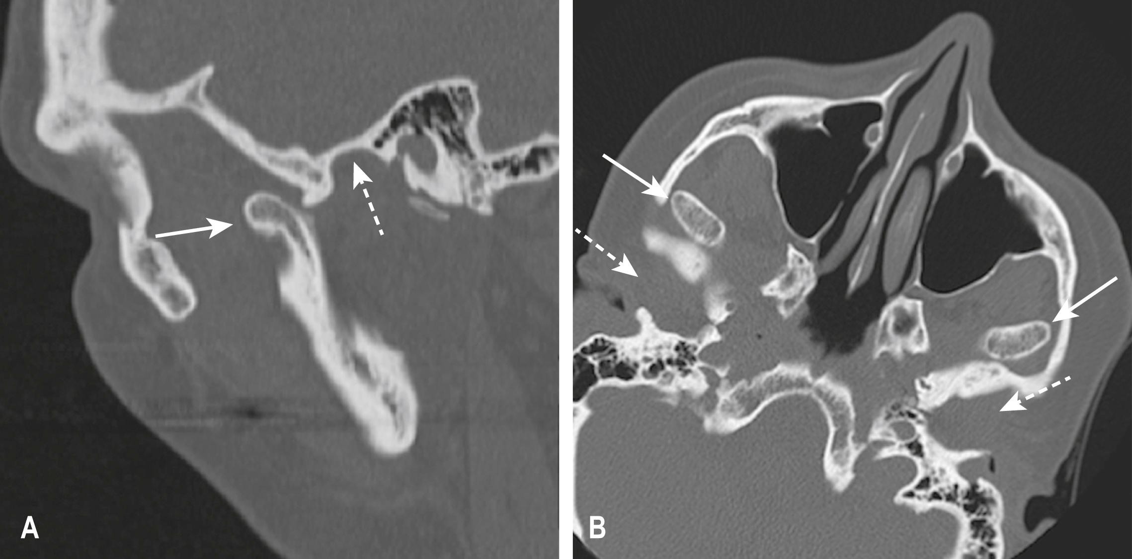 E-FIG. 3.8.6, Bilaterally Dislocated Temporomandibular Joints.