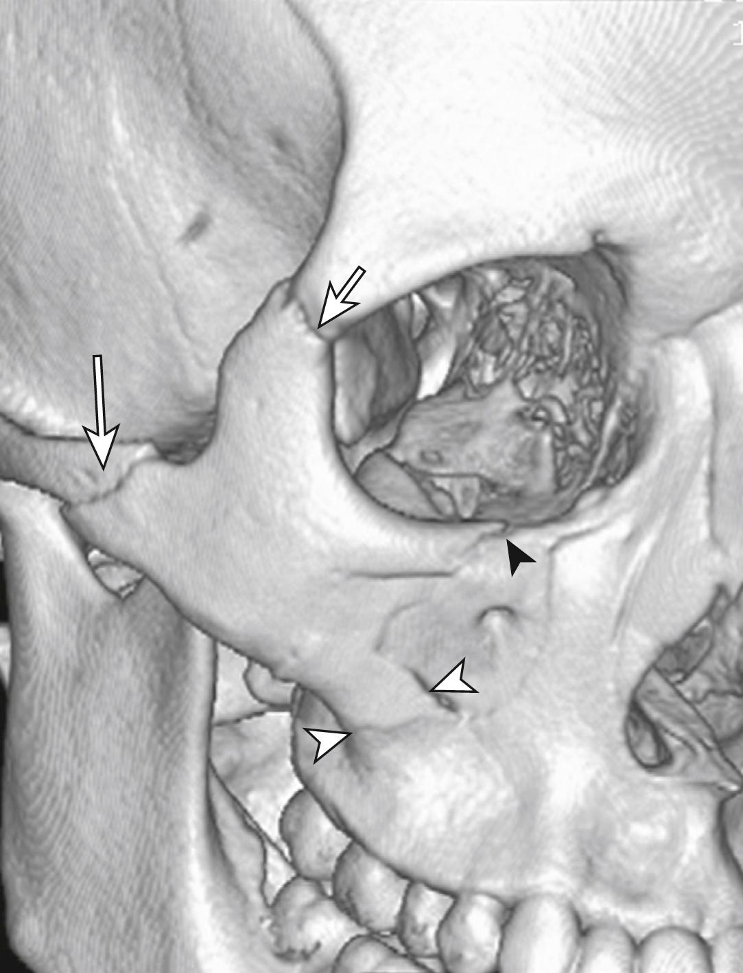 FIG. 3.8.10, Three-Dimensional Reconstruction of a Tripod Fracture.