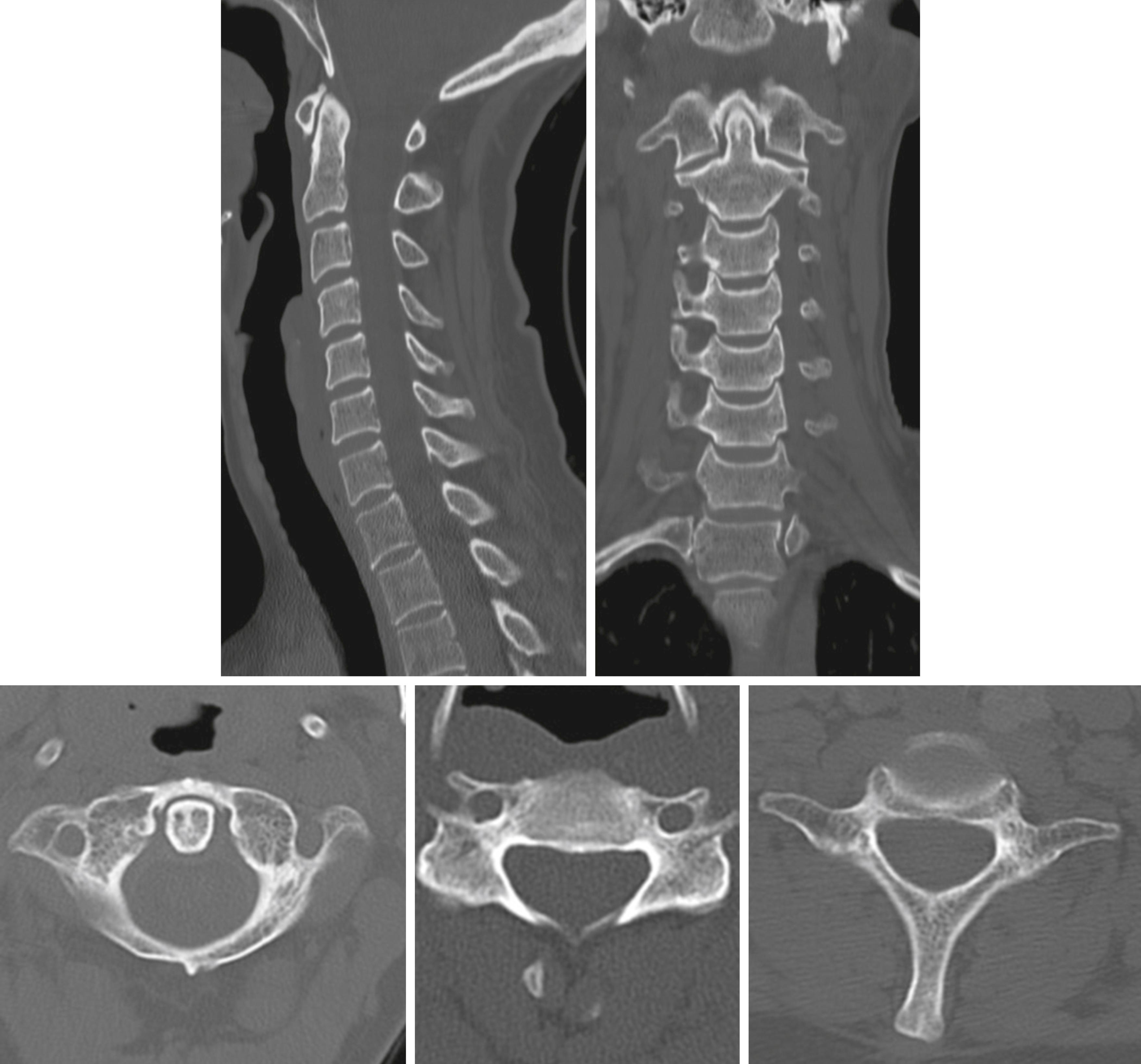 FIG. 3.8.2, Normal Computed Tomography of the Cervical Spine.