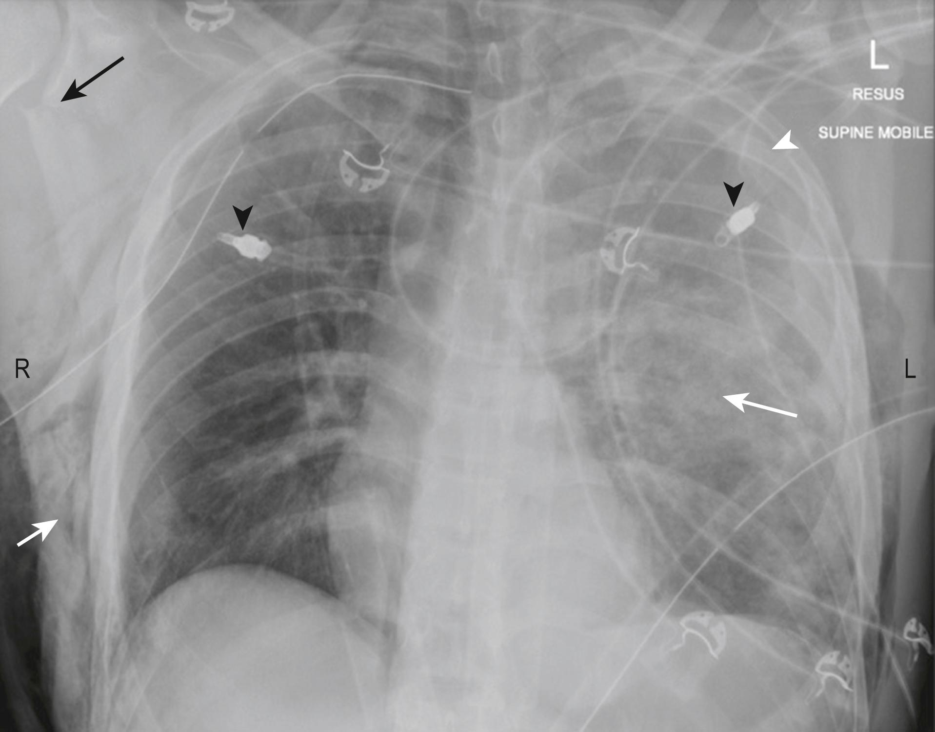 FIG. 3.8.3, Supine antero-posterior chest radiograph post-trauma showing multiple injuries: left-sided pulmonary contusion (long white arrow) and haemothorax (white arrowhead) ; right-sided pneumothorax treated with an intercostal catheter with surgical emphysema over the right lateral chest wall (short white arrow) ; right scapular fracture (black arrow) . Note bilateral catheters inserted by paramedics prior to arrival at the emergency department (black arrowheads) .