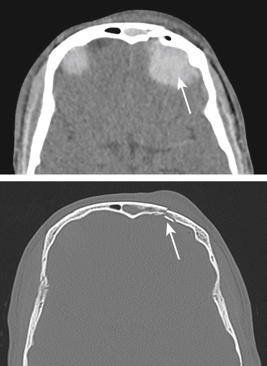 FIG. 3.8.4, Axial reconstructions of a computed tomography scan of the brain demonstrating a left frontal extradural haematoma (long white arrows) . Note the overlying comminuted and mildly depressed fracture of the left frontal bone (short white arrow ) .