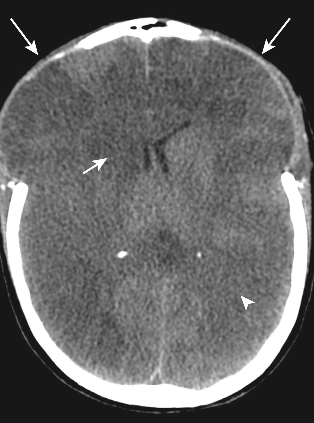 FIG. 3.8.5, Axial non-contrast computed tomography scan of the brain in a trauma patient after bi-frontal craniectomy (long arrows) to manage widespread cerebral oedema (arrowhead) . Multiple areas of infarction are present in the frontal lobes bilaterally and in the right basal ganglia (short arrow) . A catheter angiogram subsequently demonstrated multiple traumatic intracranial arterial dissections as causative.