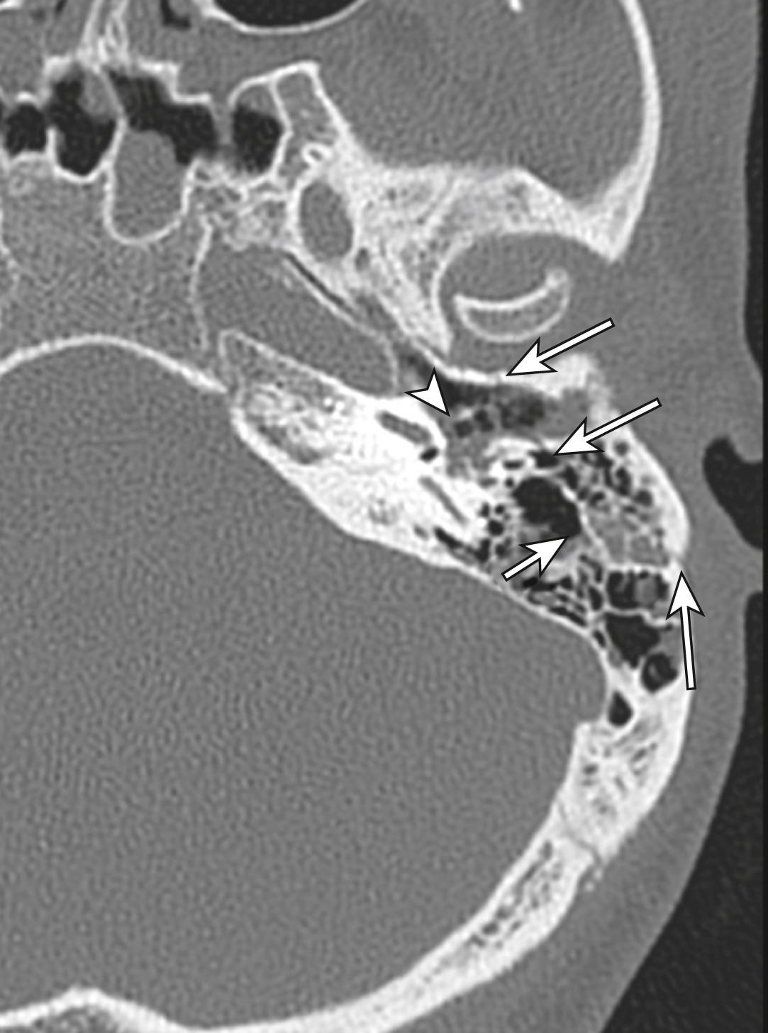 FIG. 3.8.6, Base-of-Skull Fracture in a Trauma Patient.