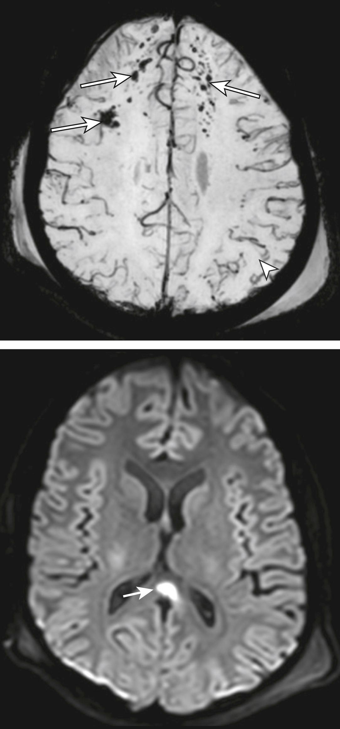 FIG. 3.8.7, Magnetic Resonance Imaging. (A) Axial gradient-echo sequence showing multiple areas of low signal intensity (long white arrows) (B) Axial diffusion-weighted image demonstrates restricted diffusion in the corpus callosum due to DAI (short white arrow) . White arrow head demonstrates normal vessels.