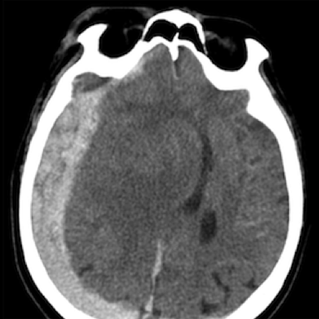 FIG. 3.8.8, Right Cerebral Convexity Subdural Haematoma.