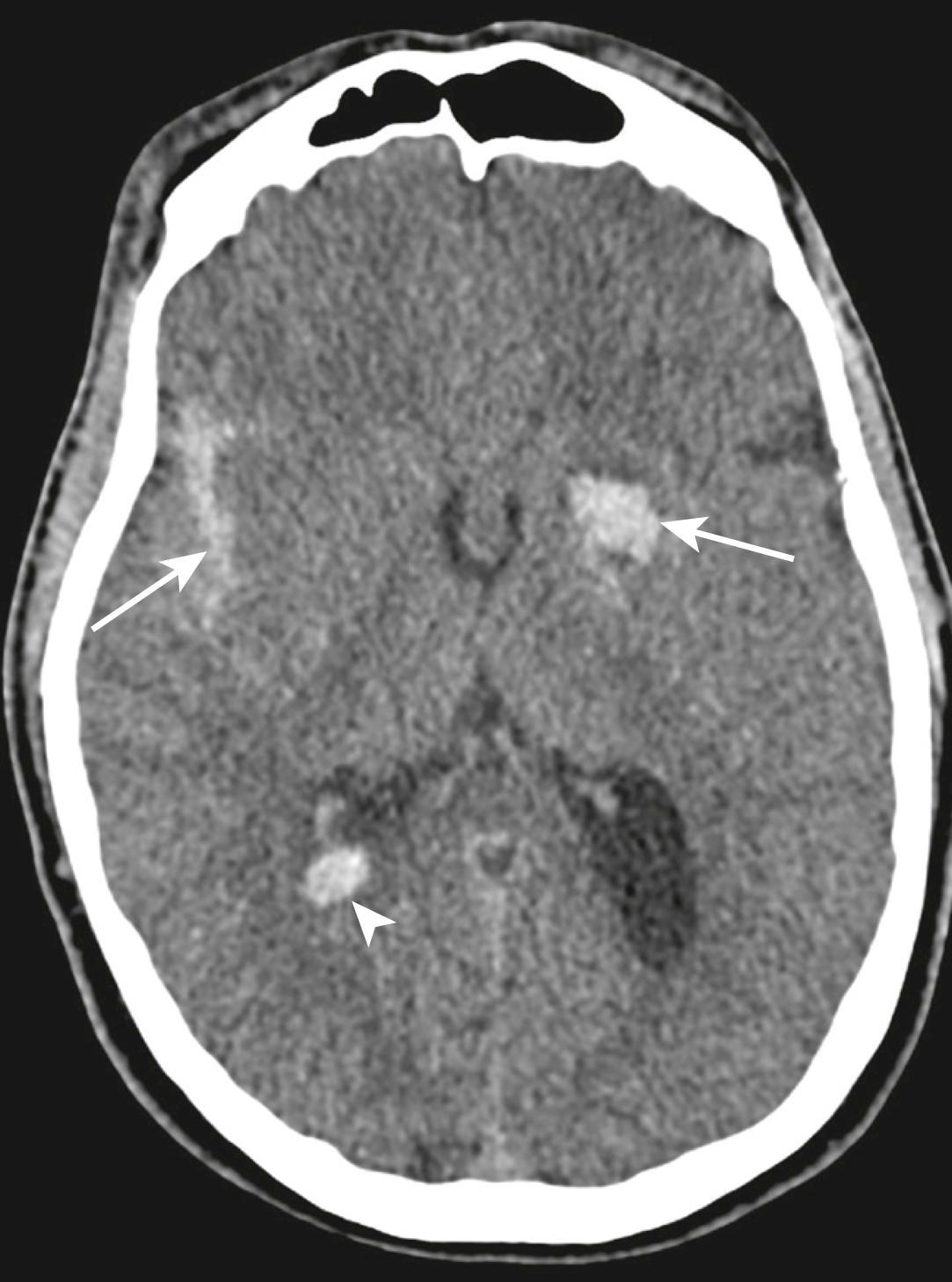 FIG. 3.8.9, Axial non-contrast computed tomography image of the brain demonstrating acute subarachnoid haemorrhage (short arrow) , parenchymal haemorrhage (long arrow) and intraventricular haemorrhage (arrowhead) in a trauma patient.