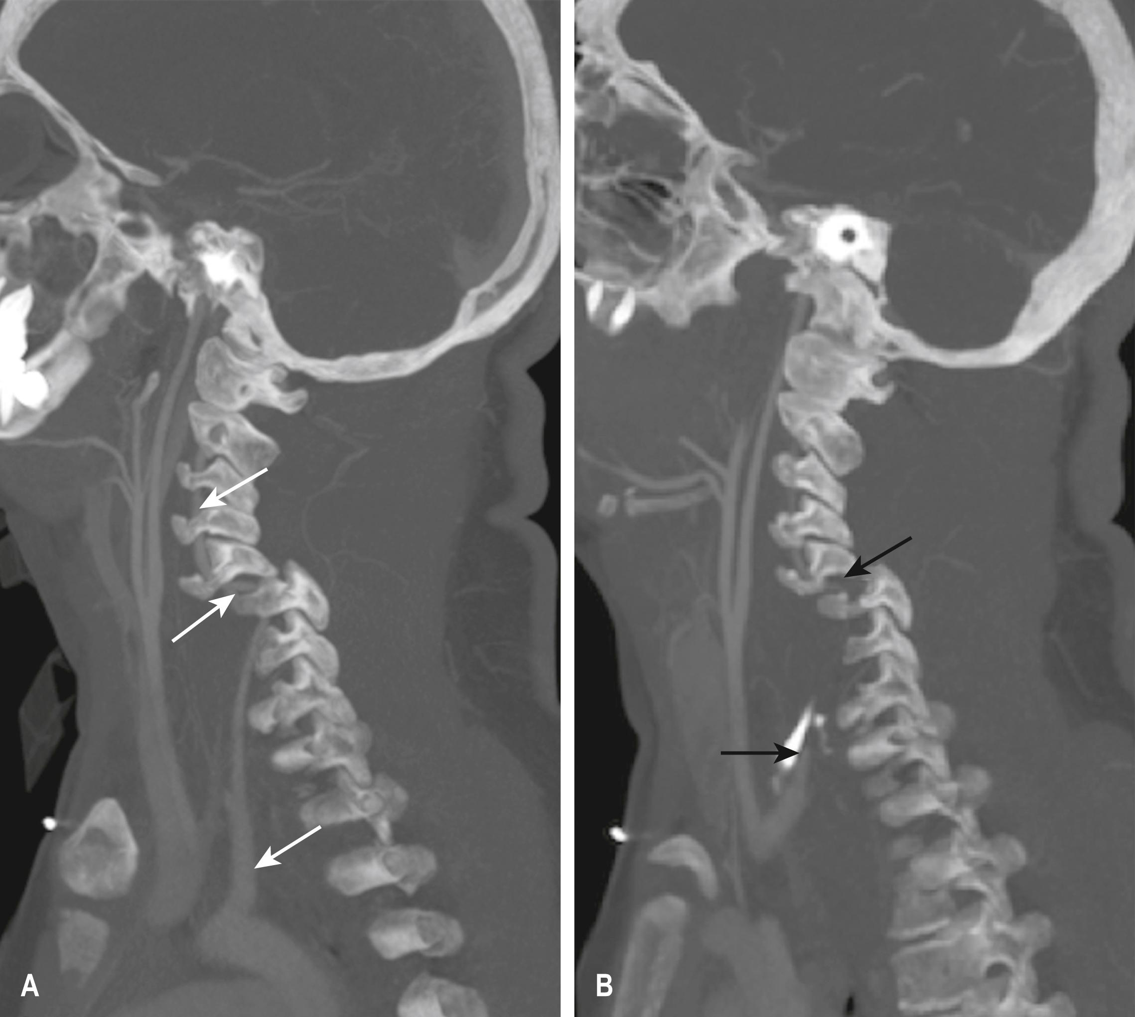 E-FIG. 3.8.1, Vertebral Artery Dissection.