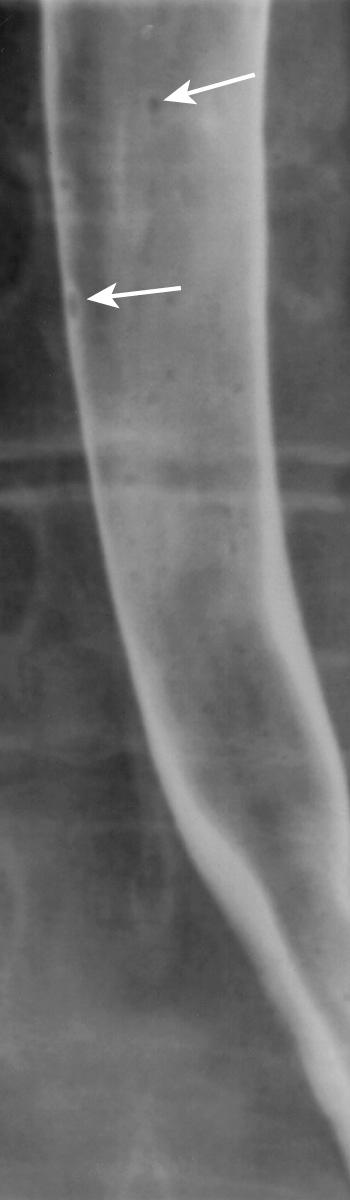 FIGURE 6.1, Normal air-contrast esophagram. The mucosa is featureless, except for the occasional tiny filling defect caused by undissolved effervescent crystals (arrows) .