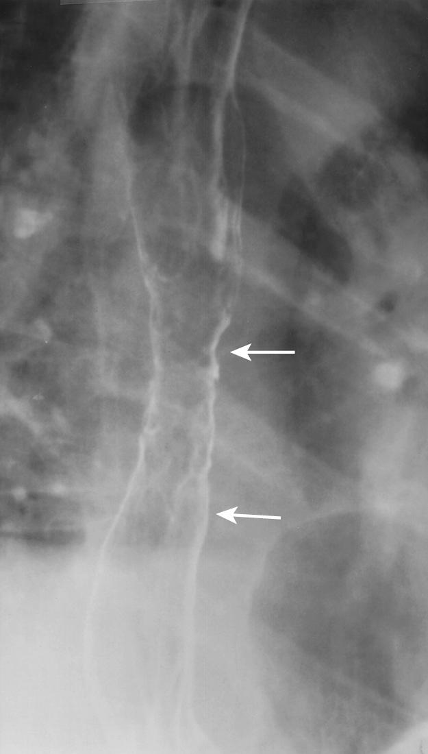 FIGURE 6.11, Barrett esophagus. Mild narrowing and a reticular mucosal pattern are apparent in the midesophagus on this upright, air-contrast image (between arrows ).