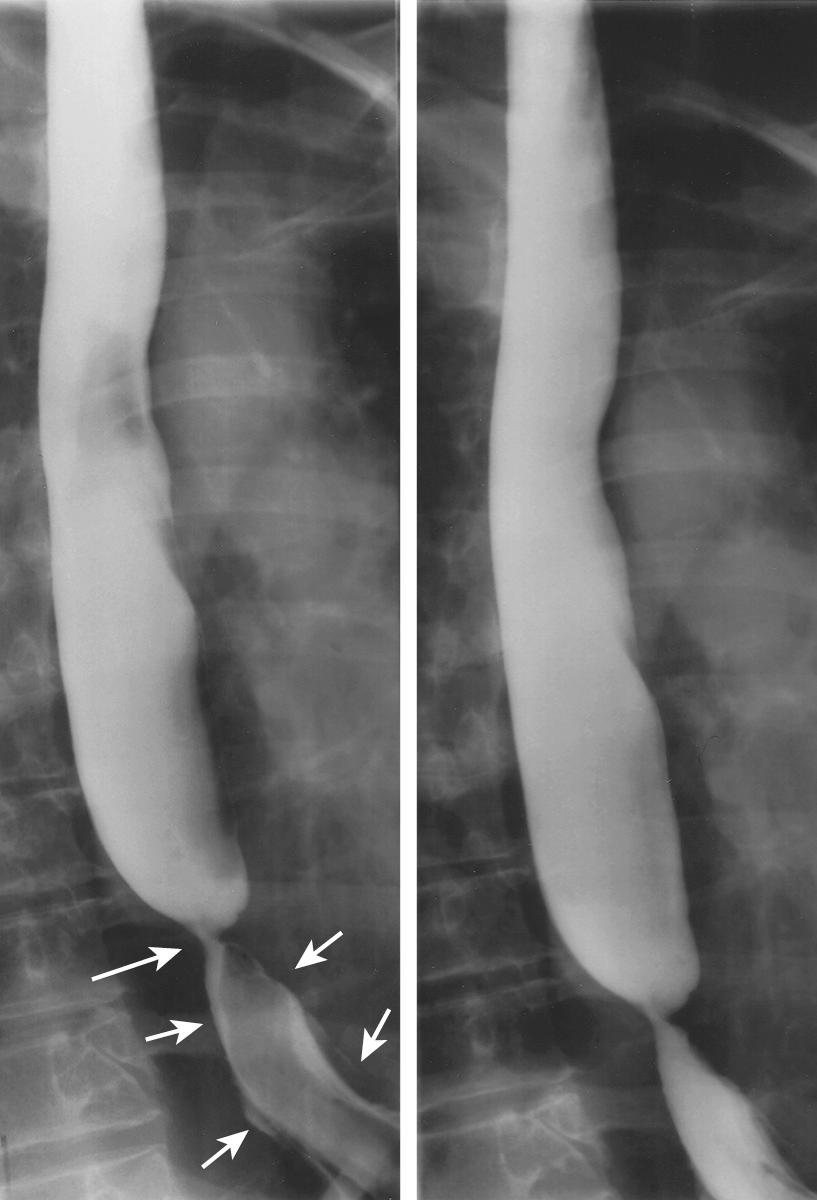 FIGURE 6.12, Scleroderma with esophageal shortening. A tight stricture at the gastroesophageal junction (large arrow) causes proximal dilatation on these prone single-contrast images. Notice that the herniated portion of the stomach demonstrates tapered shoulders and elongation (small arrows), suggesting that it has been “pulled” into the chest by the shortened esophagus.