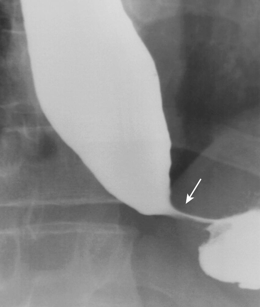 FIGURE 6.13, Classic achalasia. Prone single-contrast image demonstrates markedly dilated and atonic esophagus with tapered narrowing, “bird's beak” deformity (arrow) , at the gastroesophageal junction.