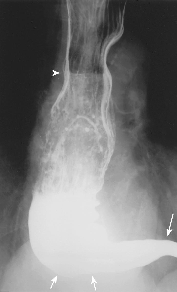 FIGURE 6.14, “Sigmoid” esophagus on upright, air-contrast, frontal image. Severe achalasia has resulted in an elongated, tortuous esophagus. The level of the distal esophagus (large arrow) is inferior to the level of the gastroesophageal junction (small arrows) contributing to even worse esophageal drainage than occurs with less-severe achalasia. Note the retained debris and air-fluid level (arrowhead) near the aortic arch.