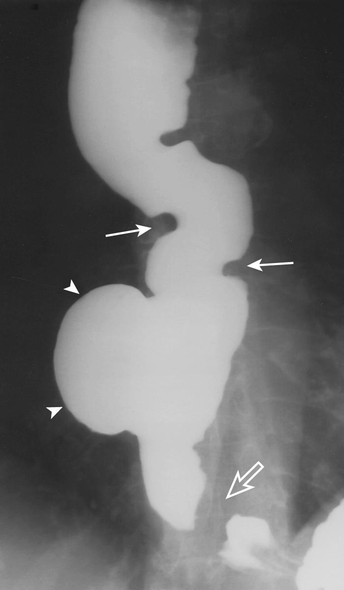 FIGURE 6.15, Vigorous achalasia suggested by a dilated esophagus with prominent tertiary contractions (arrows) and a narrow gastroesophageal junction (open arrow) above a tiny hiatal hernia. A large pulsion diverticulum (arrowheads) of the distal esophagus is also demonstrated.