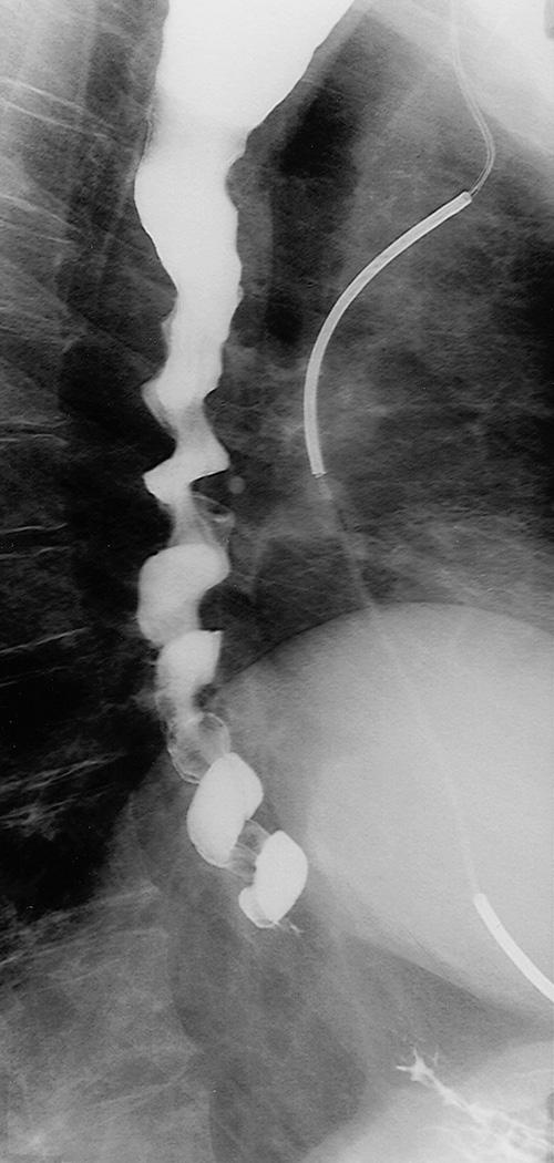 FIGURE 6.16, Diffuse esophageal spasm. Multiple tertiary contractions produce a “corkscrew” appearance of the esophagus.