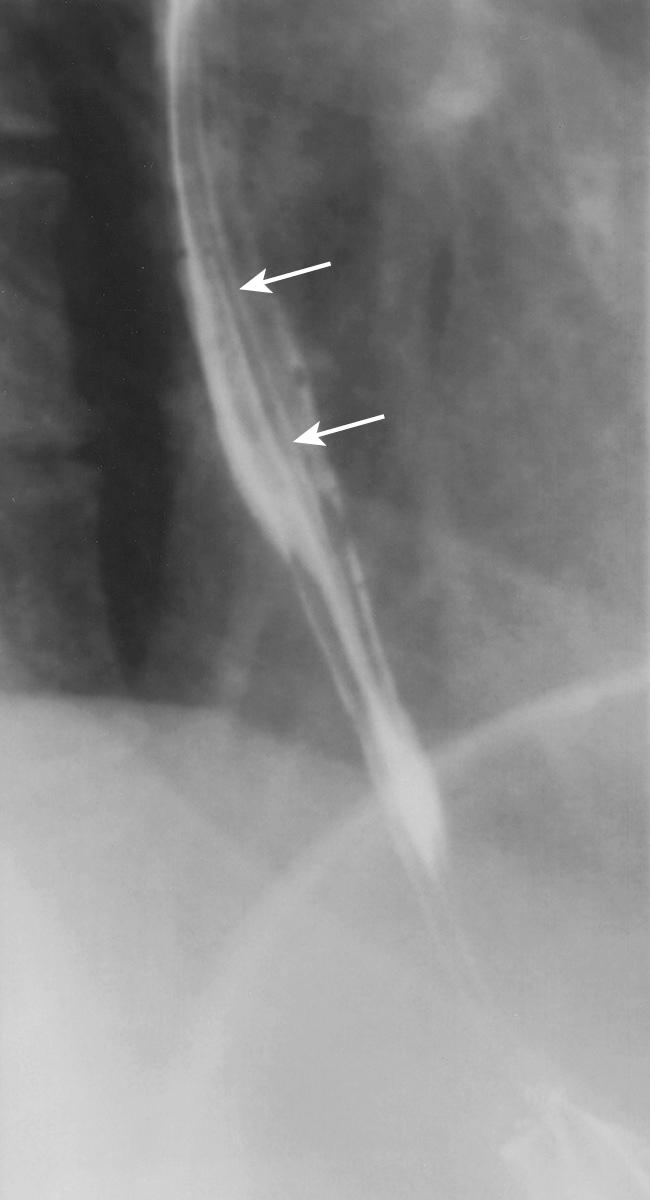 FIGURE 6.2, Normal mucosal relief esophagram. The longitudinal mucosal folds (arrows) appear smooth and continuous. They measure less than 3 mm in thickness.