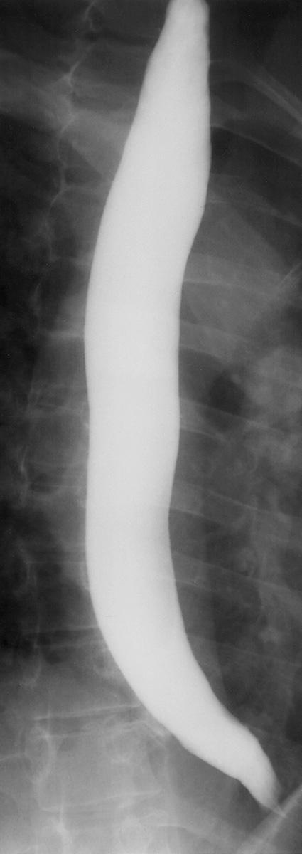 FIGURE 6.3, Normal single-contrast esophagram in prone position. The luminal margins are smooth.