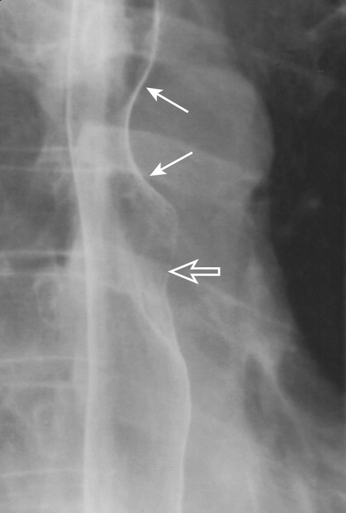 FIGURE 6.4, Upright, left posterior oblique air-contrast view demonstrating normal extrinsic impressions on the esophagus from the aortic arch (closed arrows) and left main bronchus (open arrow) .