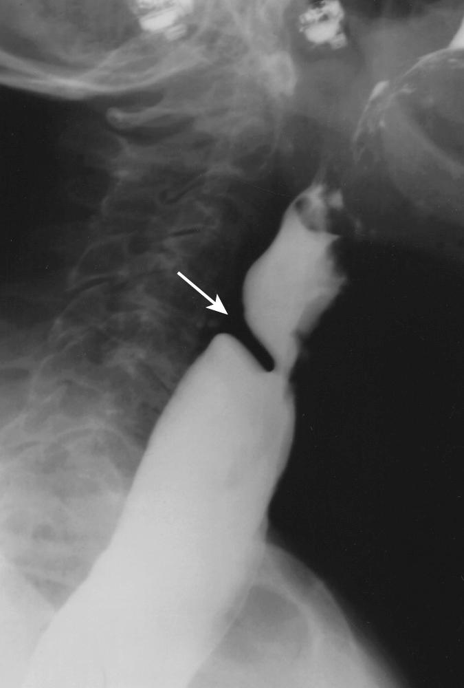 FIGURE 6.5, Cricopharyngeal bar. A smooth posterior impression at the pharyngoesophageal junction (arrow) caused by failure of cricopharyngeus muscle to relax.