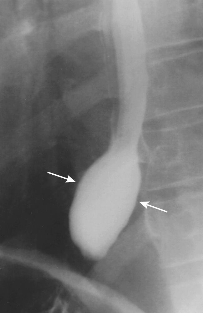 FIGURE 6.6, Esophageal ampulla (vestibule). The caliber of the normal esophagus increases slightly just superior to the level of the gastroesophageal junction (arrows) .