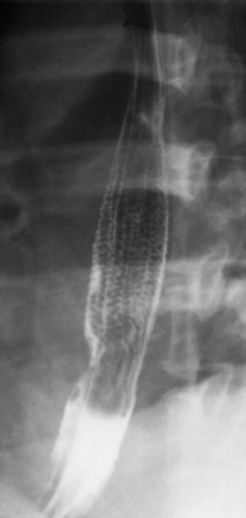 FIGURE 6.7, Feline esophagus. Closely spaced, transient, transverse mucosal folds, presumed secondary to longitudinal muscle contractions, typically occur immediately after an episode of gastroesophageal reflux.