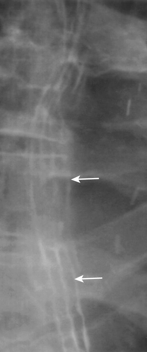 FIGURE 6.8, Acute reflux esophagitis. Mucosal relief view demonstrates irregular thickening of the longitudinal folds of the esophagus (arrows) .