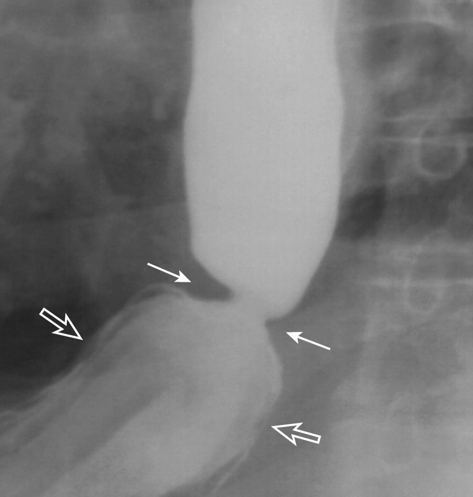 FIGURE 6.9, Esophageal stricture secondary to gastroesophageal reflux disease. Asymmetric narrowing (closed arrows) is evident at the gastroesophageal junction above a hiatal hernia (open arrows) . This stricture is thicker, more asymmetric, and slightly more irregular than the Schatzki ring demonstrated in Fig. 6.36 .