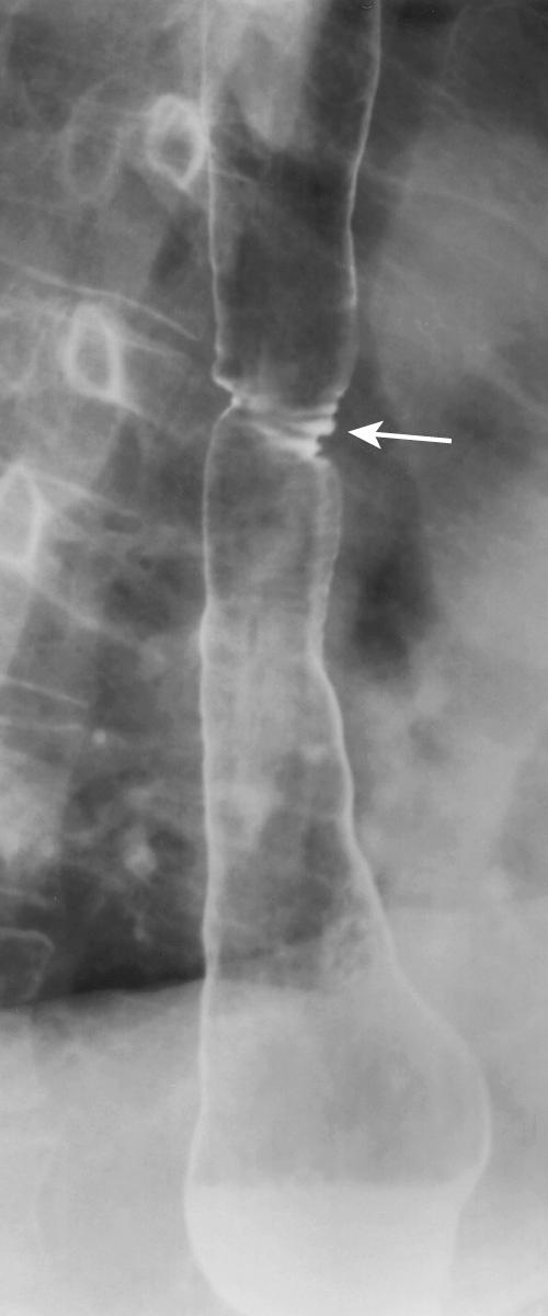 FIGURE 6.10, Midesophageal scarring secondary to gastroesophageal reflux disease. Transverse scars (arrow) are typical for a benign stricture caused by gastroesophageal reflux disease. However, the location of this stricture, many centimeters proximal to the gastroesophageal junction, suggests the presence of Barrett metaplasia between gastroesophageal junction and this stricture.