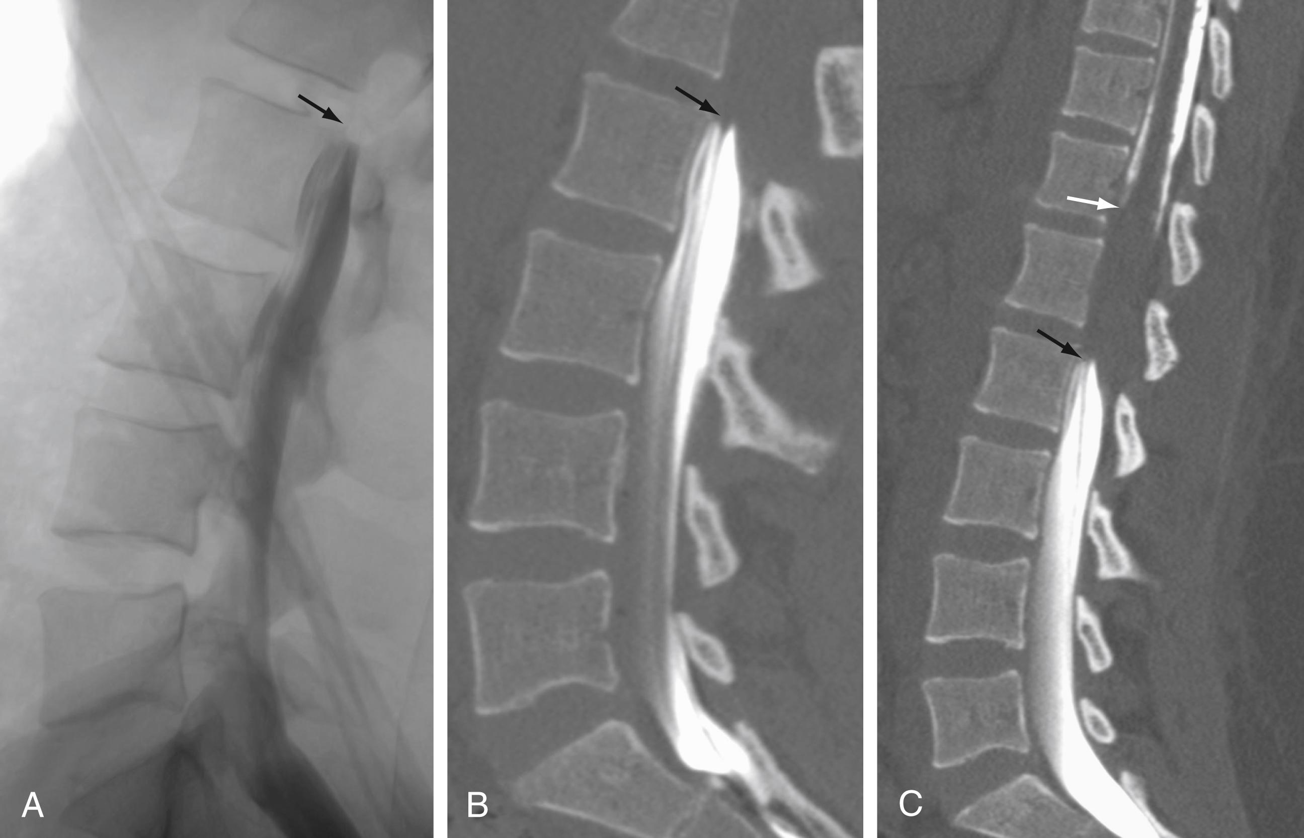 Figure 11.1, Myelographic image (A) and CT myelogram (B) demonstrate lack of cranial extension of contrast material (myelographic block) secondary to epidural extension of metastatic disease (black arrows). CT myelogram (C) defines the superior extent of disease (white arrow) after intrathecal contrast injection at the C1–C2 level (not shown).