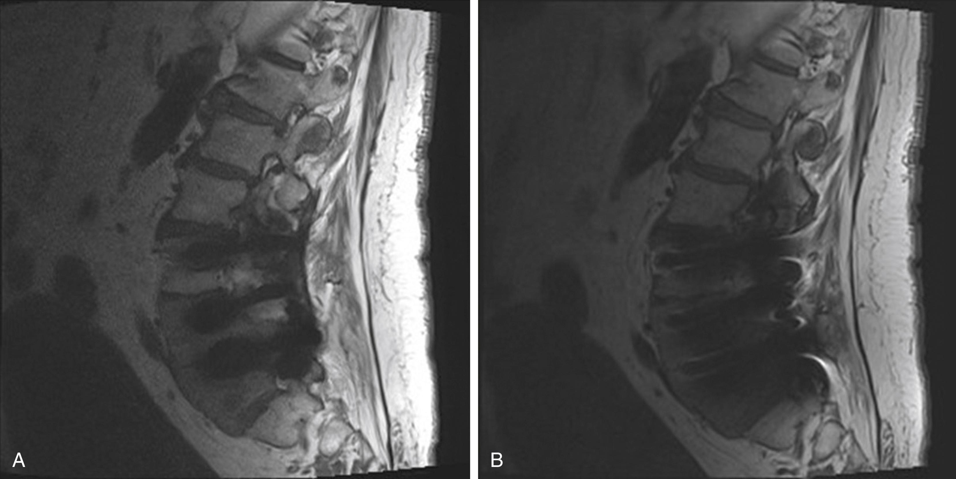 Figure 11.11, Metal artifact reduction.