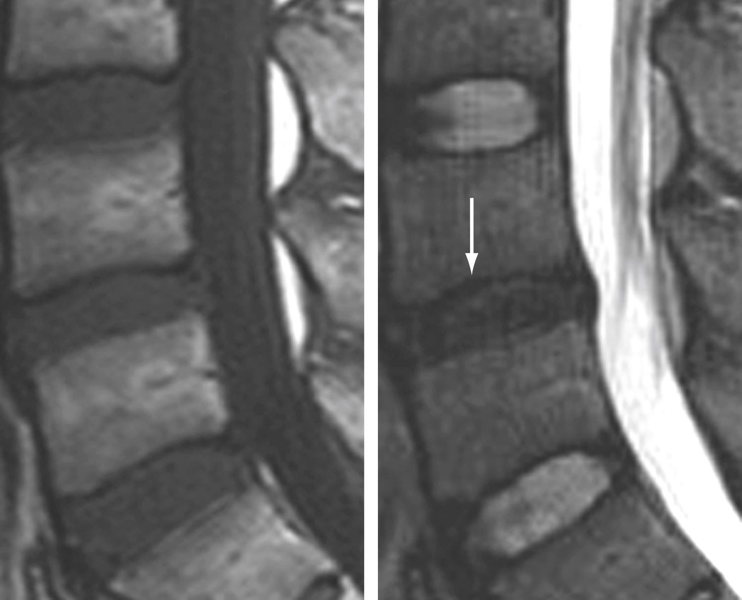 Figure 11.12, Degenerative disk disease.