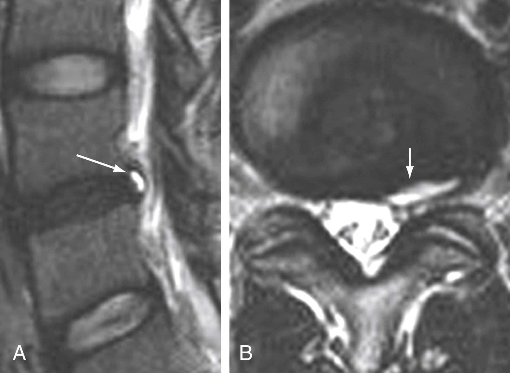 Figure 11.13, Annular tear on parasagittal (A) and axial (B) T2-weighted images through the L4–L5 intervertebral disk. Note the high signal intensity in the outer annulus/longitudinal ligament complex, which represents the area of annular disruption (arrows).