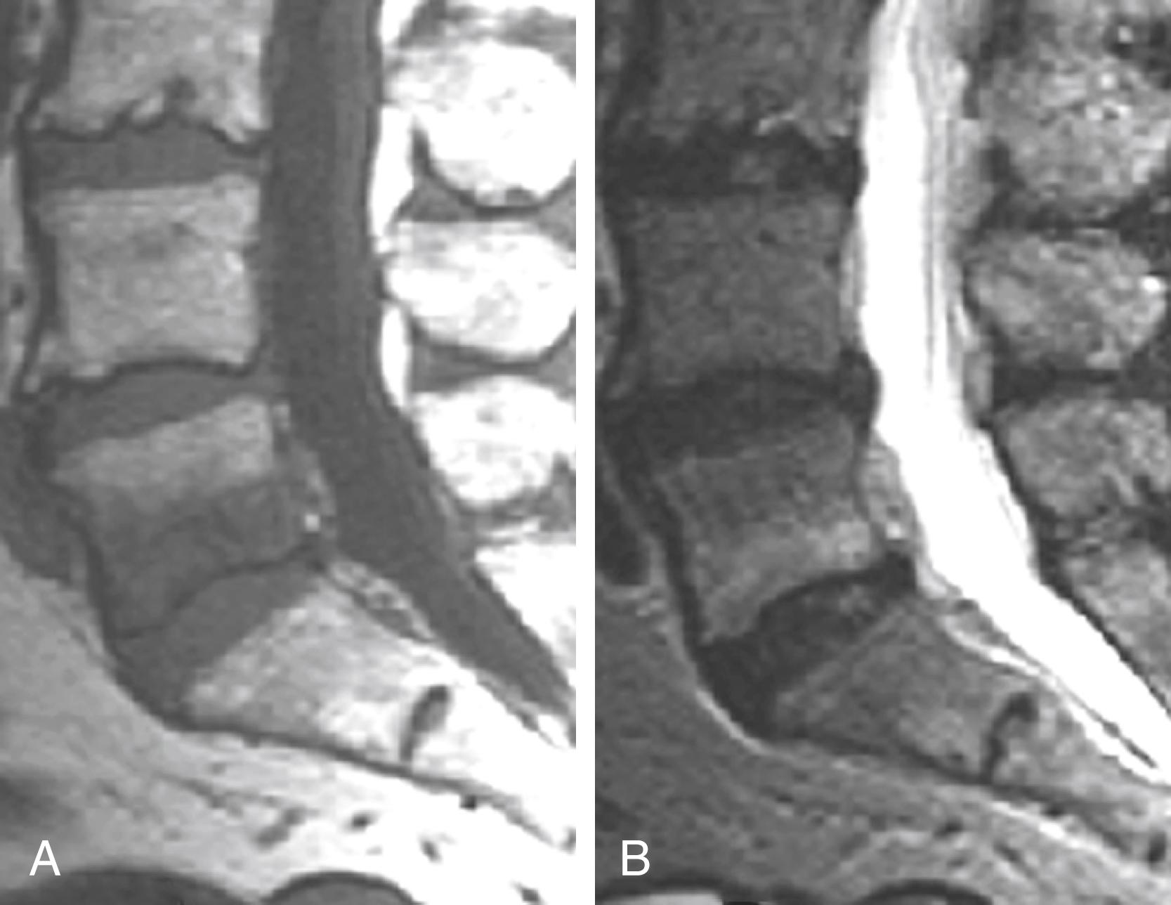 Figure 11.16, Type I degenerative marrow changes.