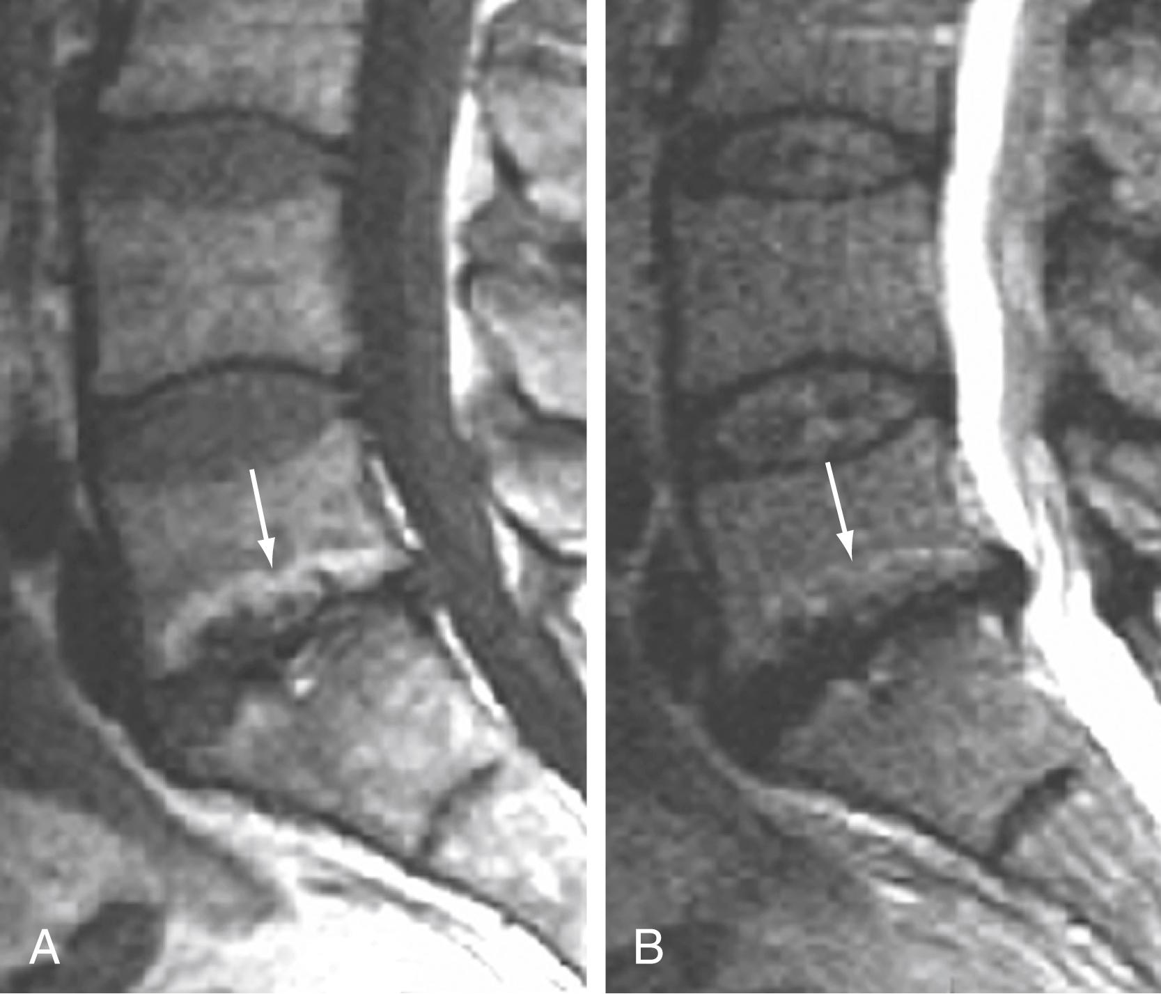 Figure 11.17, Type II degenerative marrow change (arrows).