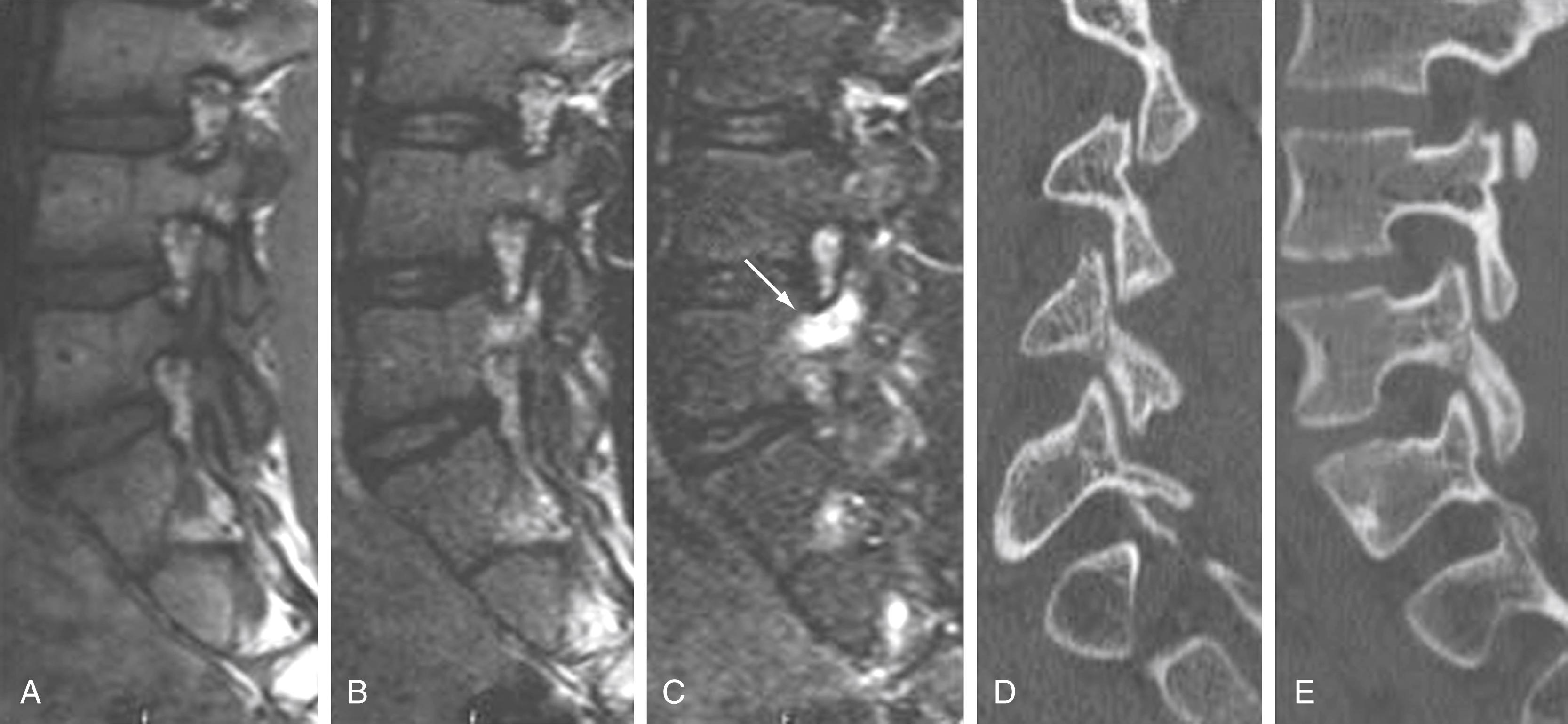 Figure 11.19, Pedicle hyperintensity/pars interarticularis fracture.