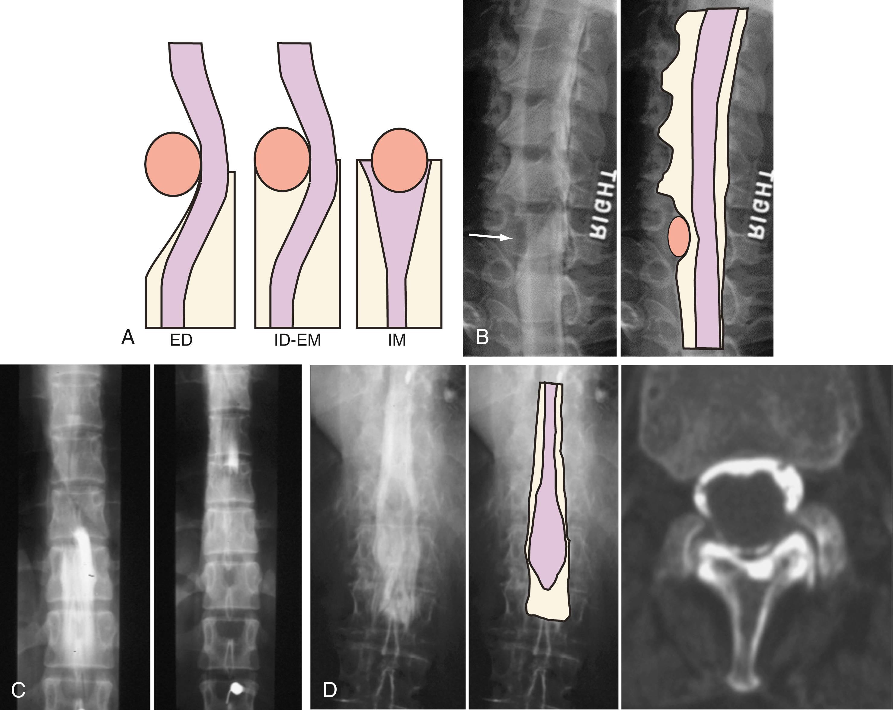 Figure 11.2, (A) Diagrammatic representation of extradural (ED), intradural extramedullary (ID-EM), and intramedullary (IM) lesions of the spine. Purple, spinal cord; orange, mass; tan, subarachnoid space. (B) Oblique view from a cervical myelogram demonstrating an extradural defect (arrow) from a herniated disk at the C6–C7 level with cutoff of the nerve root. The superimposed diagram demonstrates the typical concave inward appearance of an extradural defect. (C) Anteroposterior (AP) radiographs from a thoracic myelogram demonstrating an intradural extramedullary lesion. Contrast agent was introduced into the subarachnoid material below the lesion on the left radiograph and at the C1–C2 level to outline the superior extent of the lesion on the right radiograph. Leftward displacement of the spinal cord silhouette is visible. (D) Left and middle, AP views from a thoracic myelogram demonstrating an intramedullary mass at the conus. The contrast column in the subarachnoid space is splayed around the intramedullary mass. CT myelogram (right) demonstrates the enlarged conus.