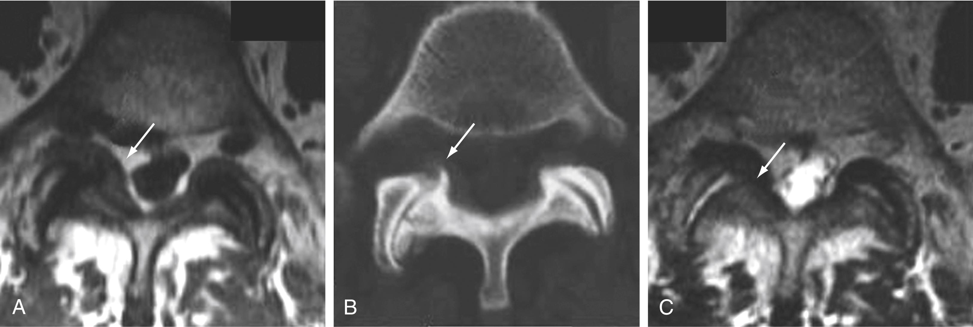 Figure 11.21, Degenerative facet changes.