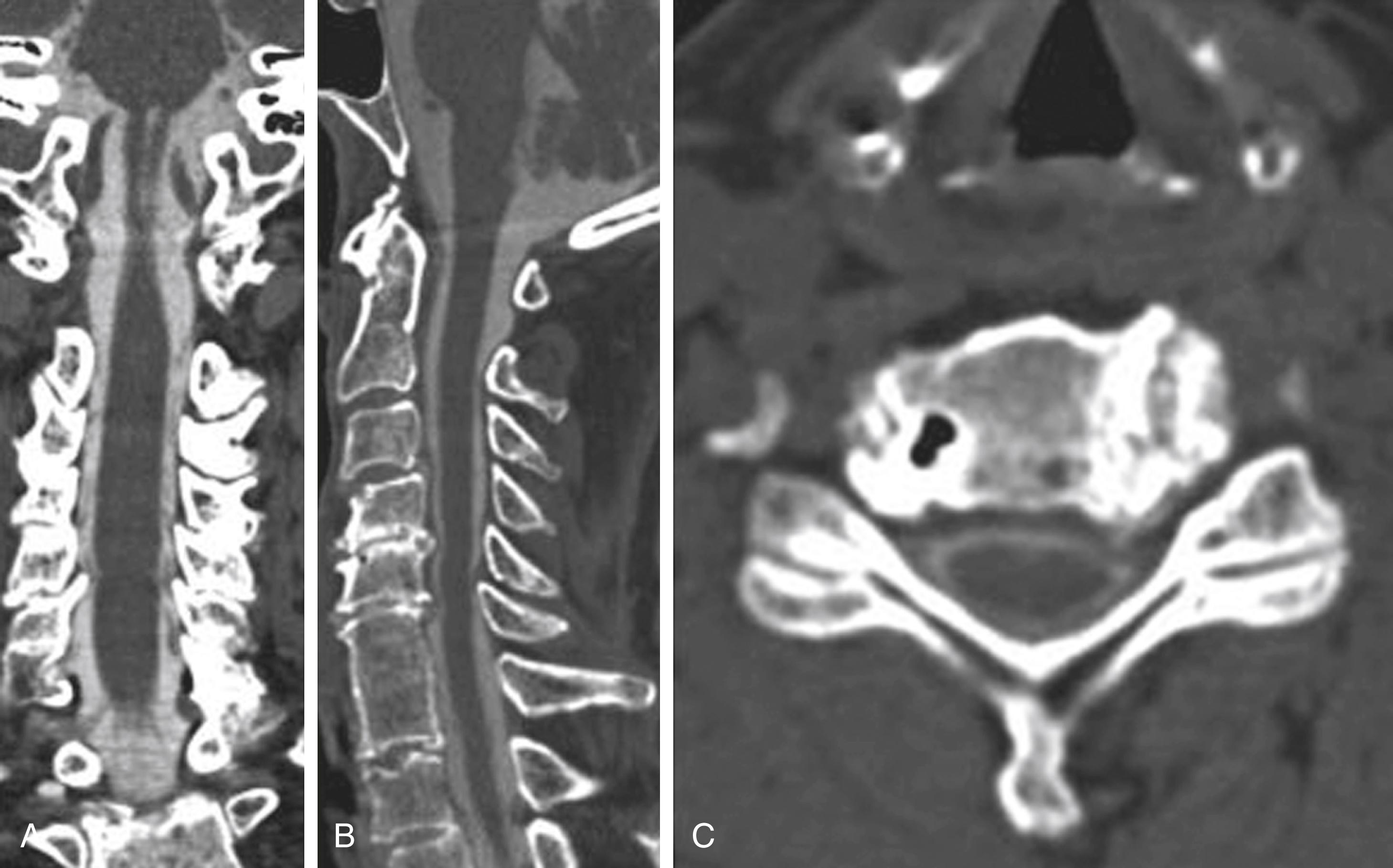 Figure 11.3, Coronal (A) and sagittal (B) multiplanar reformatted CT myelograms obtained from the axial data set (C). Hypertrophic degenerative changes of the vertebral body margins and uncinate processes are producing extradural indentations on the subarachnoid space.