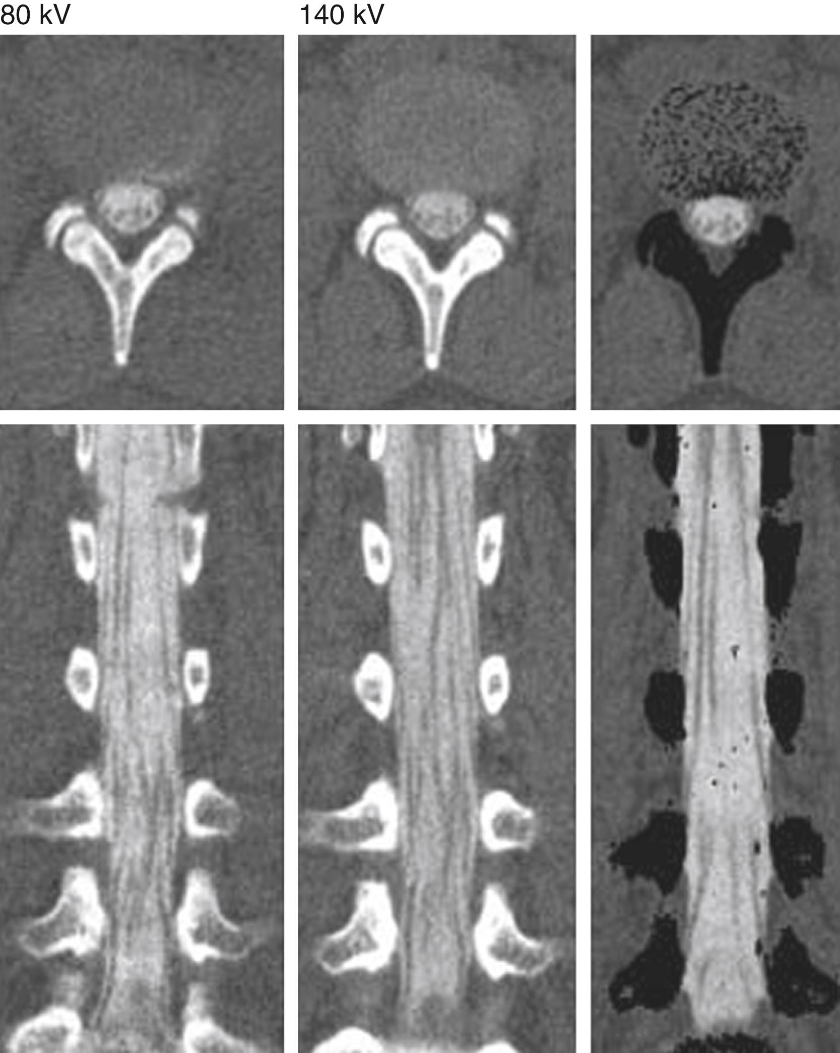 Figure 11.4, Dual-energy subtraction CT myelography.