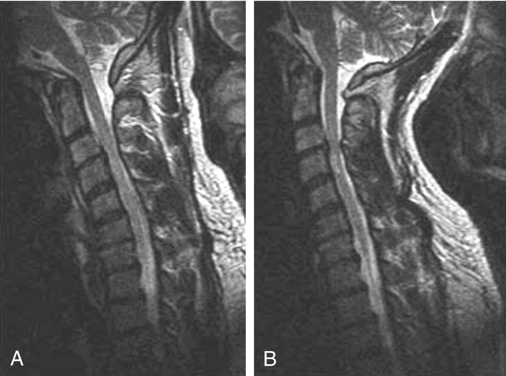 Figure 11.6, Sagittal T2-weighted spin echo images through the cervical spine in flexion (A) and extension (B). Note the decreased anterior-posterior canal diameter on the extension image (7 versus 4 mm) at the C3–C4 level.