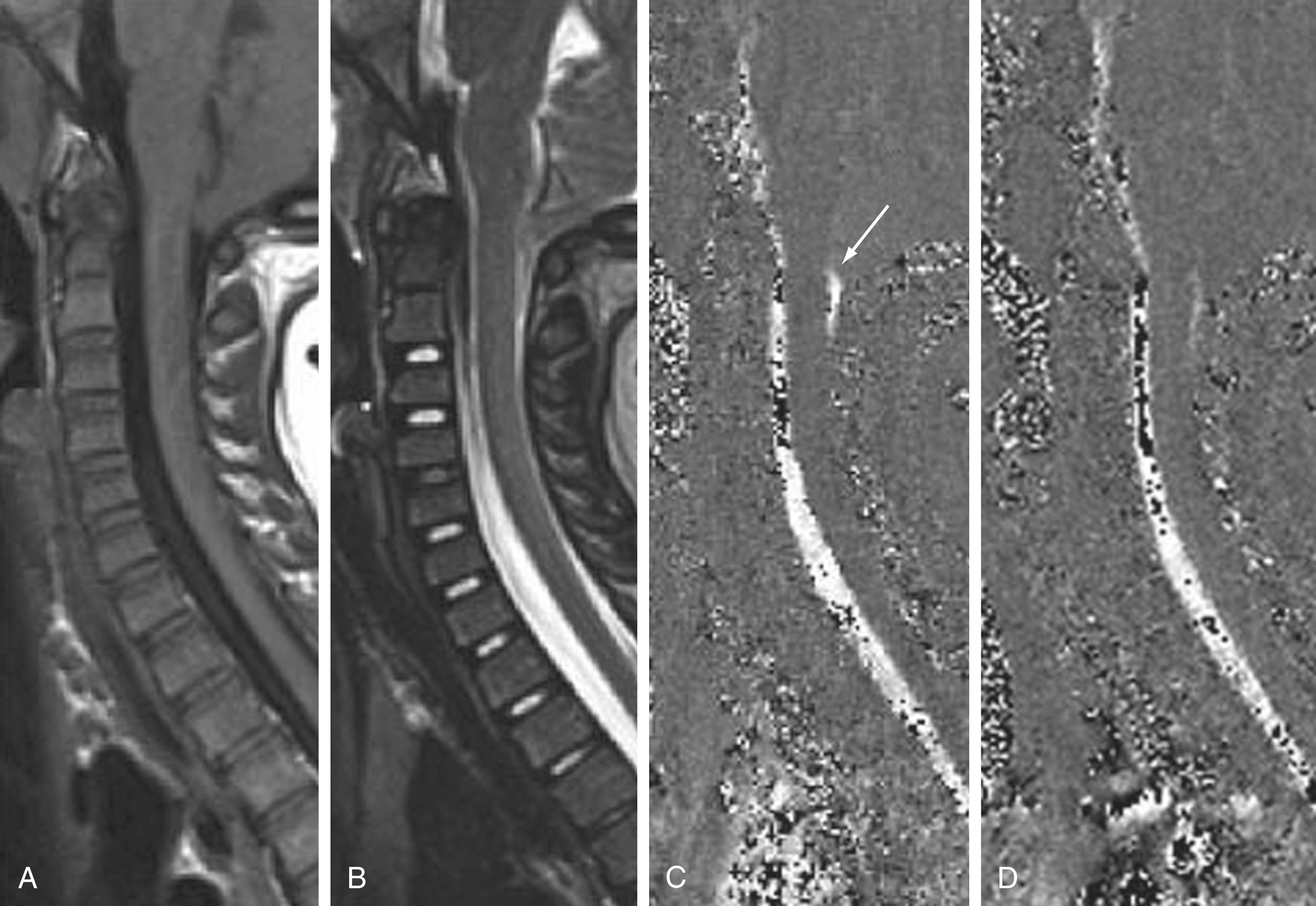 Figure 11.7, Sagittal T1-weighted (A), T2-weighted (B), and cerebrospinal fluid (CSF) flow studies (C and D) of the craniovertebral junction in a patient with a Chiari I malformation. Note that the majority of CSF flow is within the basal cisterns and ventral to the cervical cord. Only a small amount of CSF flow is identified dorsally (C, arrow ).