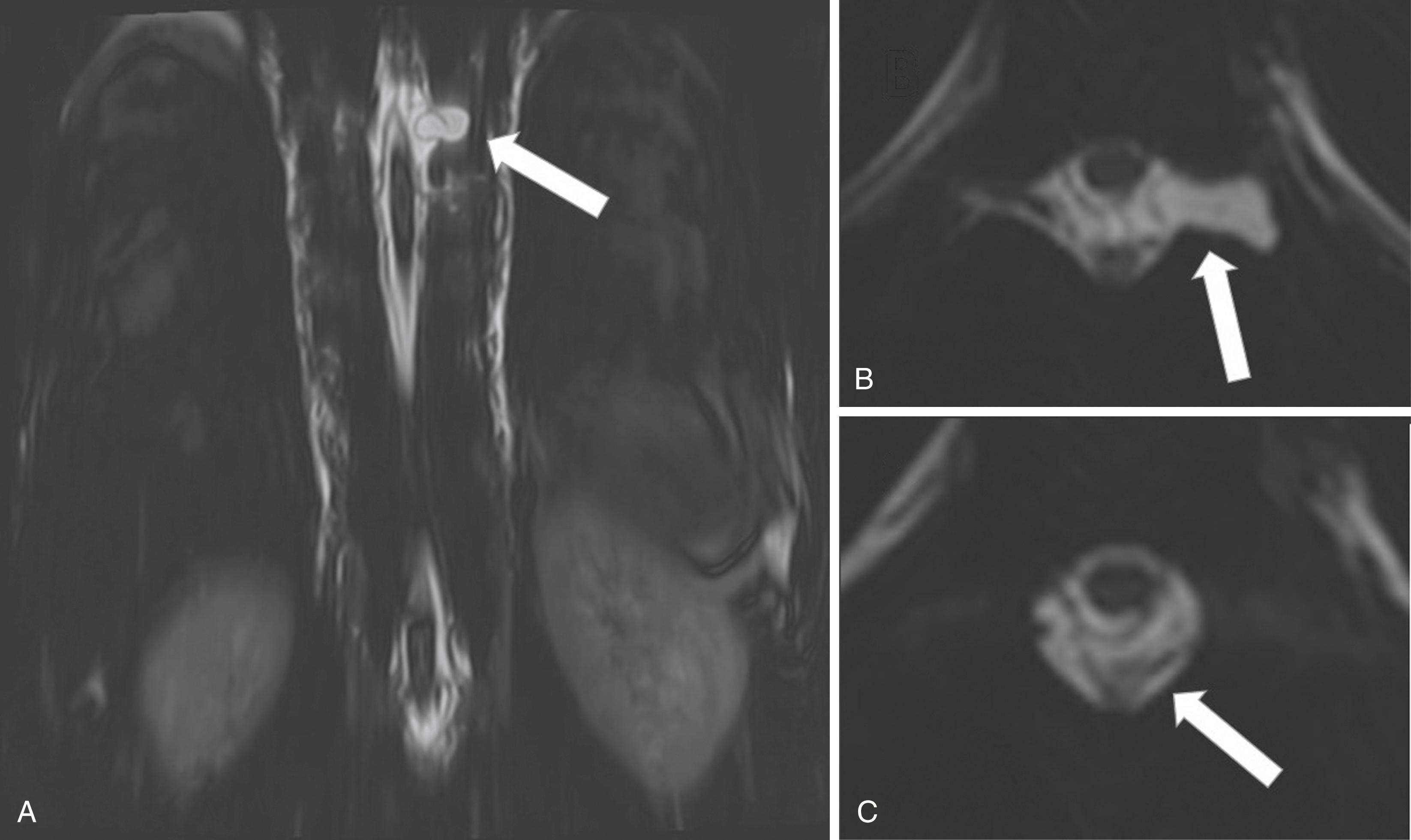 Figure 11.8, Coronal (A) and axial (B) images from high-resolution T2-weighted MR myelography demonstrates a large perineural cyst that has spontaneously ruptured. The axial images (C) demonstrate a large dorsal subdural collection that has resulted from the cerebrospinal fluid leak.