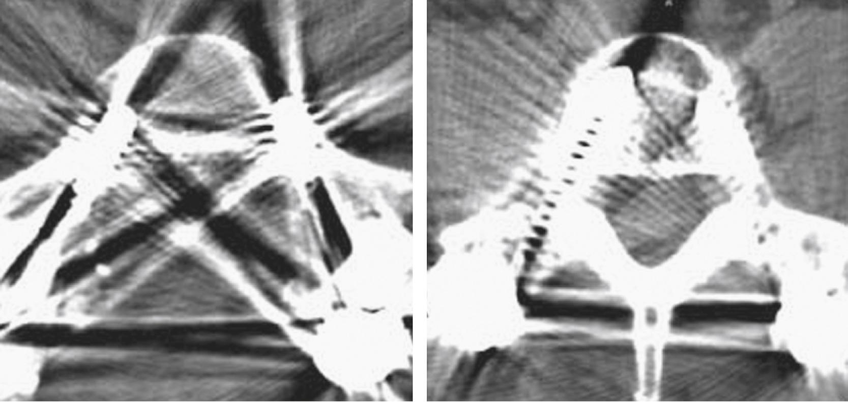 Figure 11.9, Beam-hardening artifact on axial CT images, caused by pedicle screws.