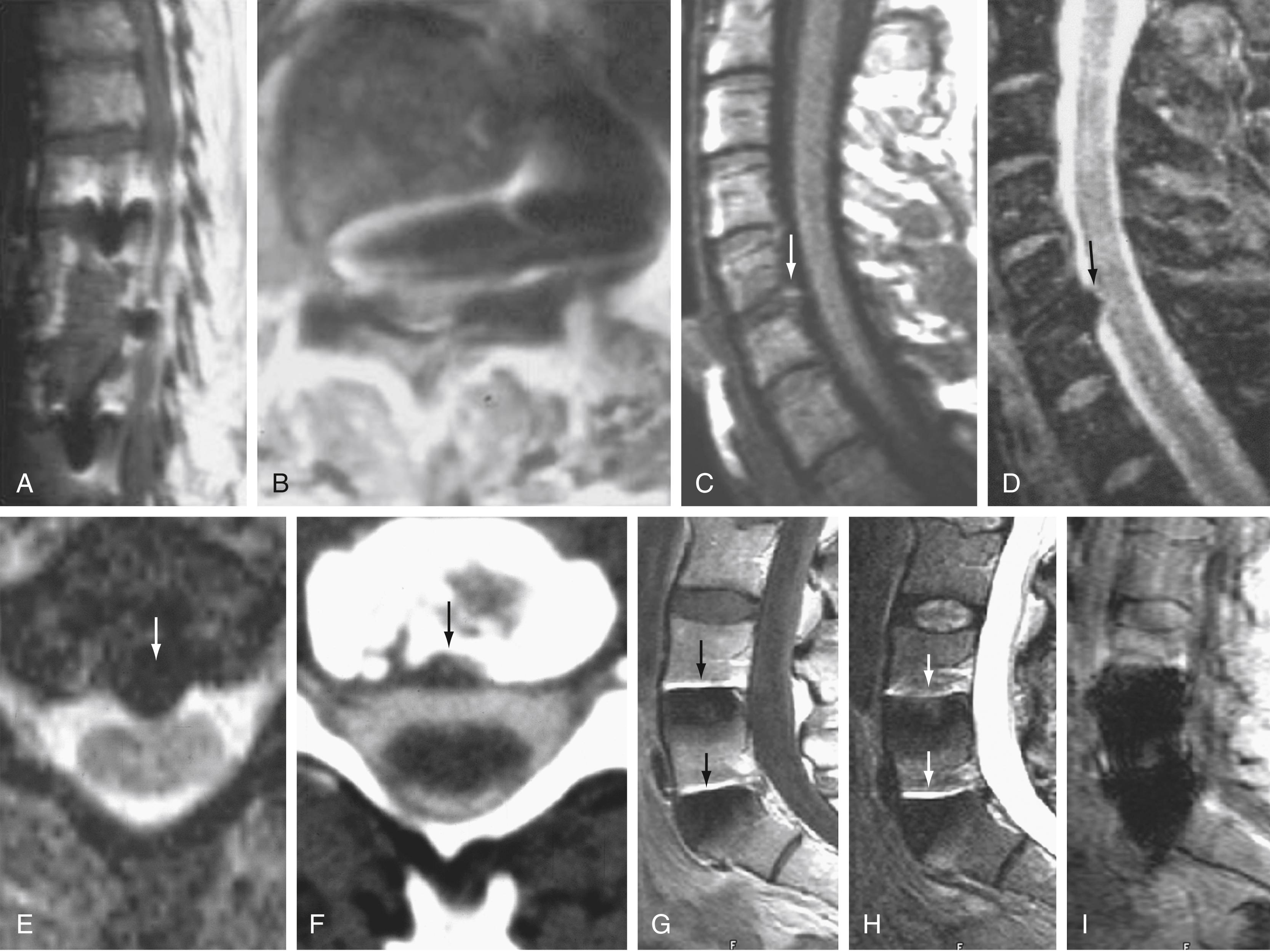 Figure 11.10, Metallic artifacts on sagittal (A) and axial (B) T1-weighted images through the thoracic spine in a patient with steel rods. There is a geometric artifact with complete distortion of the image as a result of the stainless steel. On the sagittal T1-weighted image (C), a small extradural defect is noted at the C5–C6 level (white arrow). This defect appears more prominent on the sagittal gradient echo image (D, black arrow ). On the axial gradient echo image (E), this defect (white arrow) appears to be midline. Axial CT myelogram (F) shows postsurgical changes (black arrow) but no evidence of an extradural defect. These changes are secondary to a susceptibility effect produced by small shards of metal that are often noted on MR images after surgery but are too small to be visible on CT images or plain radiographs. The susceptibility artifact can be mistaken for a recurrent disk herniation or for an osteophyte. In a patient with a metallic intradiscal fixation device at the L4–L5 and L5–S1 levels, note that the susceptibility artifact is less prominent on the sagittal T1-weighted sequence (G, black arrows ) than on the sagittal T2-weighted image (H, white arrows ) . It is most prominent on the gradient echo image (I) because of its heightened sensitivity to field inhomogeneity and susceptibility changes.