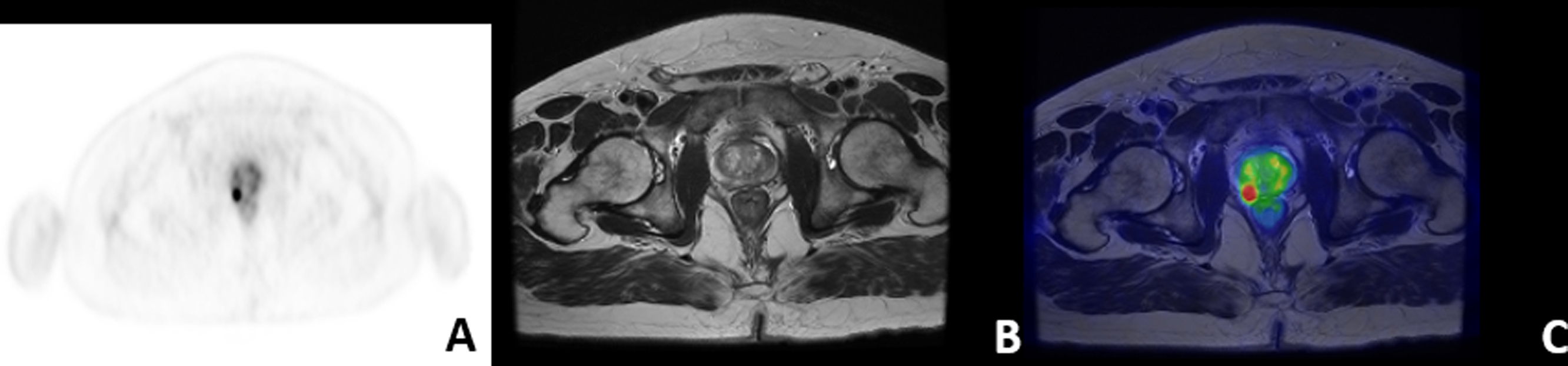 Figure 15.2, PET/MRI simultaneous acquisition in PCa. (A): transaxial 68 Ga-PSMA PET; (B): Axial T2-weighted sequence; (C): 68 Ga-PSMA PET/MRI (Eudract number 2018-001034-18).