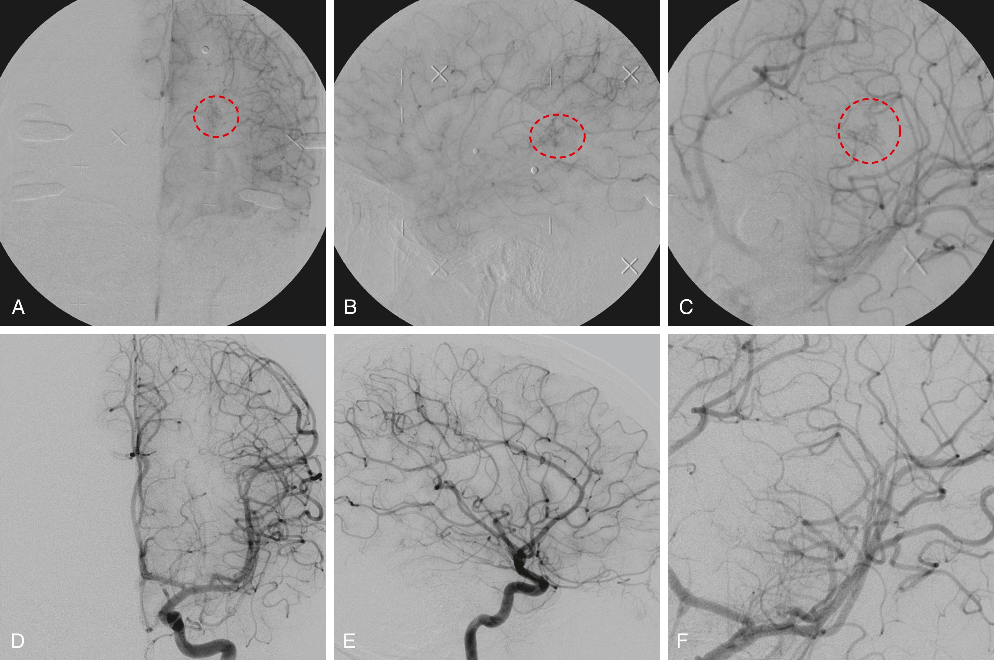 FIGURE 96.1, (A–F) This was an 11-year-old male with a history of a large left-sided intracerebral hemorrhage in 2007, and subsequent neuroimaging demonstrated a small left basal ganglia arteriovenous malformation (AVM). Digital subtraction angiography (DSA) in the anteroposterior (A), lateral (B), and oblique (C) views demonstrated a left basal ganglia Spetzler-Martin grade III AVM that measured 1.2 × 1 × 0.6 cm (red dashed circles) . The AVM was fed by mildly enlarged lenticulostriate arteries, with deep venous drainage into the left thalamostriate vein. There was no evidence of associated aneurysms. Approximately 6 months after the hemorrhage, the patient underwent stereotactic radiosurgery (Gamma Knife) using a margin dose of 25 Gy to the 50% isodose line and three isocenters. Follow-up DSA (D–F) in 2009 demonstrated complete obliteration of the AVM.