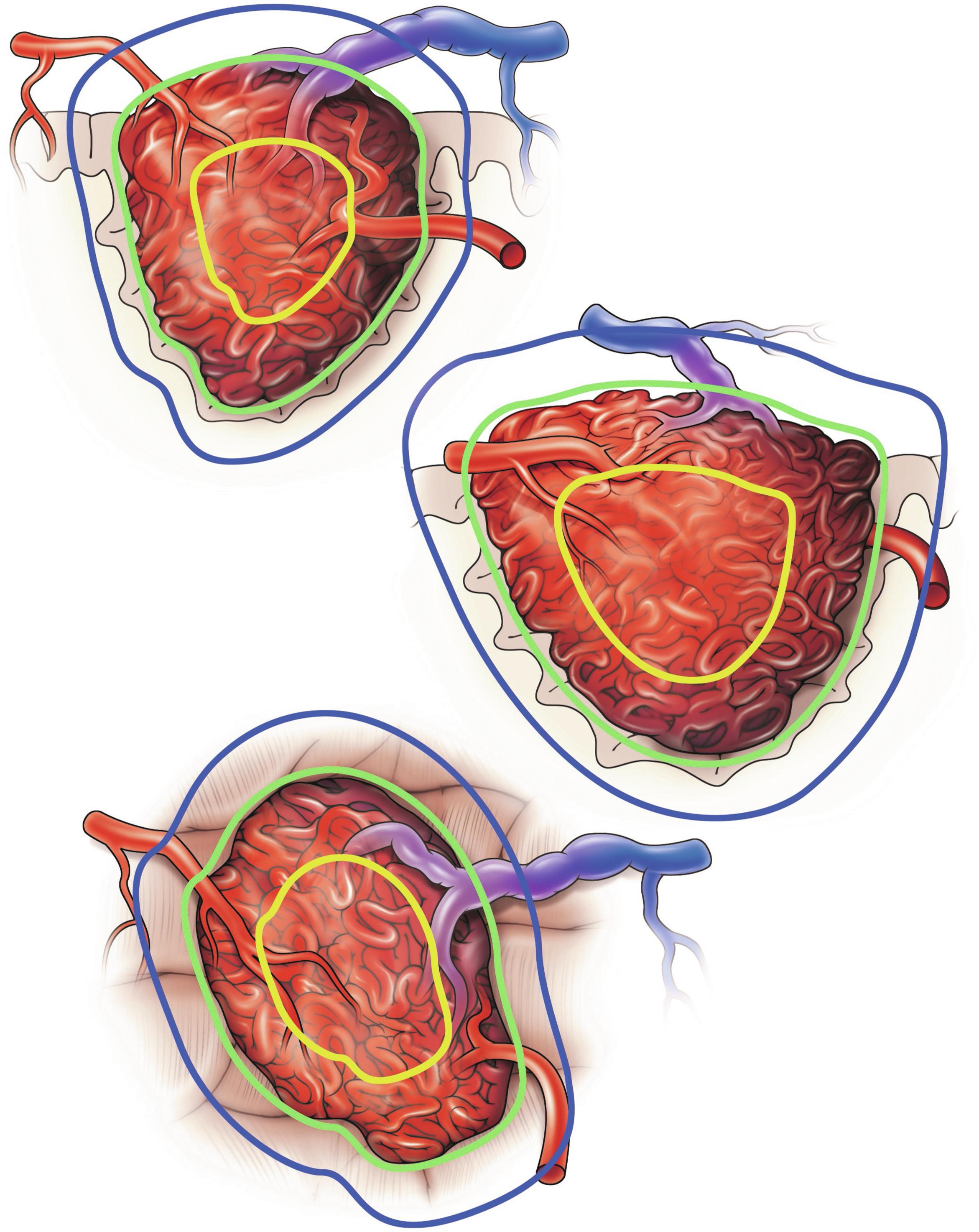 Fig. 40.1, Three views of a single AVM showing its components (arteries, interval nidus, and draining veins), with a desired targeting of the nidus and sparing of veins and surrounding cortex. For the purposes of stereotactic radiosurgery (SRS) planning, the 3D view allows a more complete understanding of the extent of an AVM than a 2D view does. These three views show the contours of the AVM from different angles, with the yellow outline showing the SRS capture. Delivering radiation at multiple angles allows healthy brain tissue to be spared during radiosurgical obliteration of the AVM.