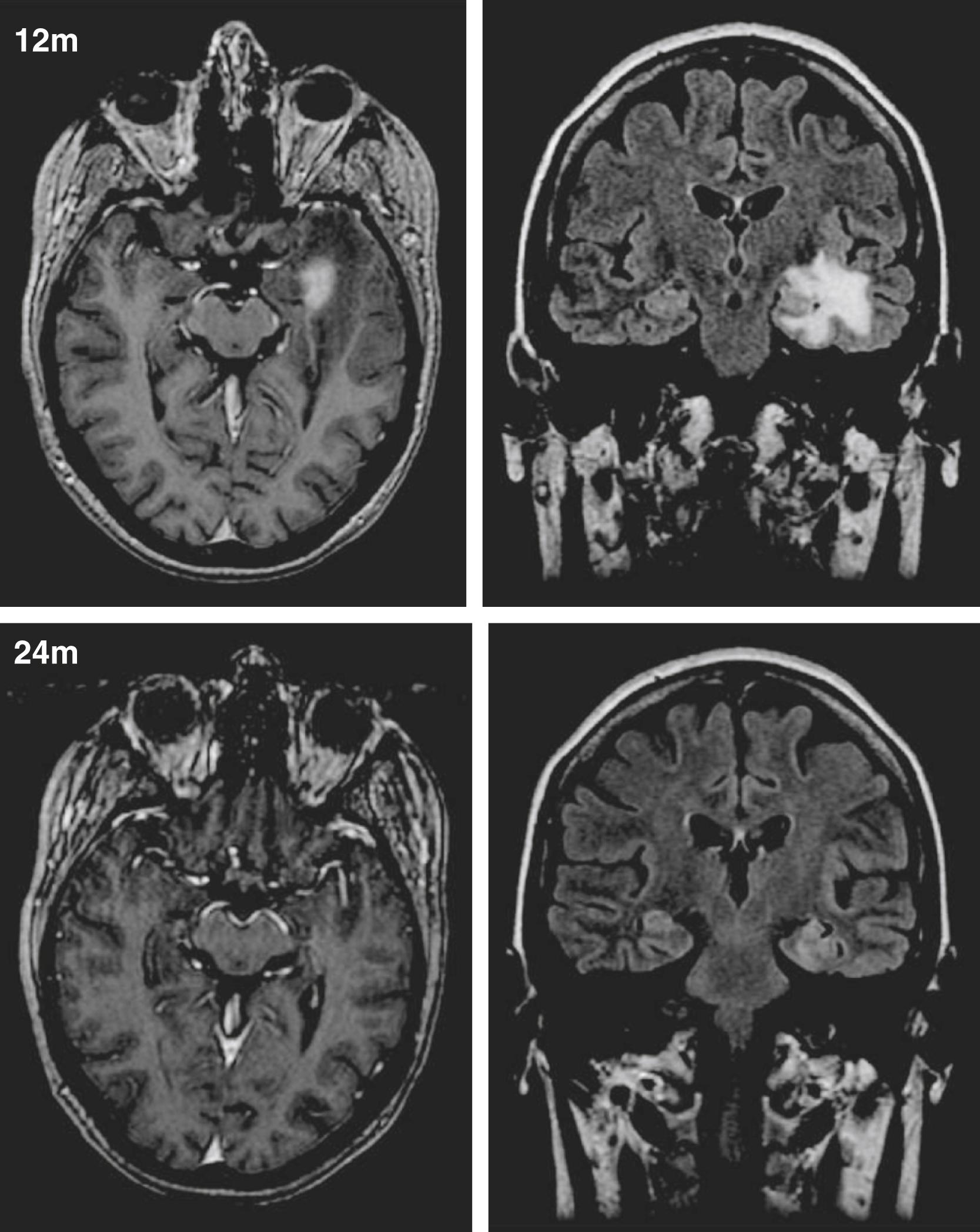 Figure 97.2, Changes on MRI at 12 and 24 months after radiosurgery.